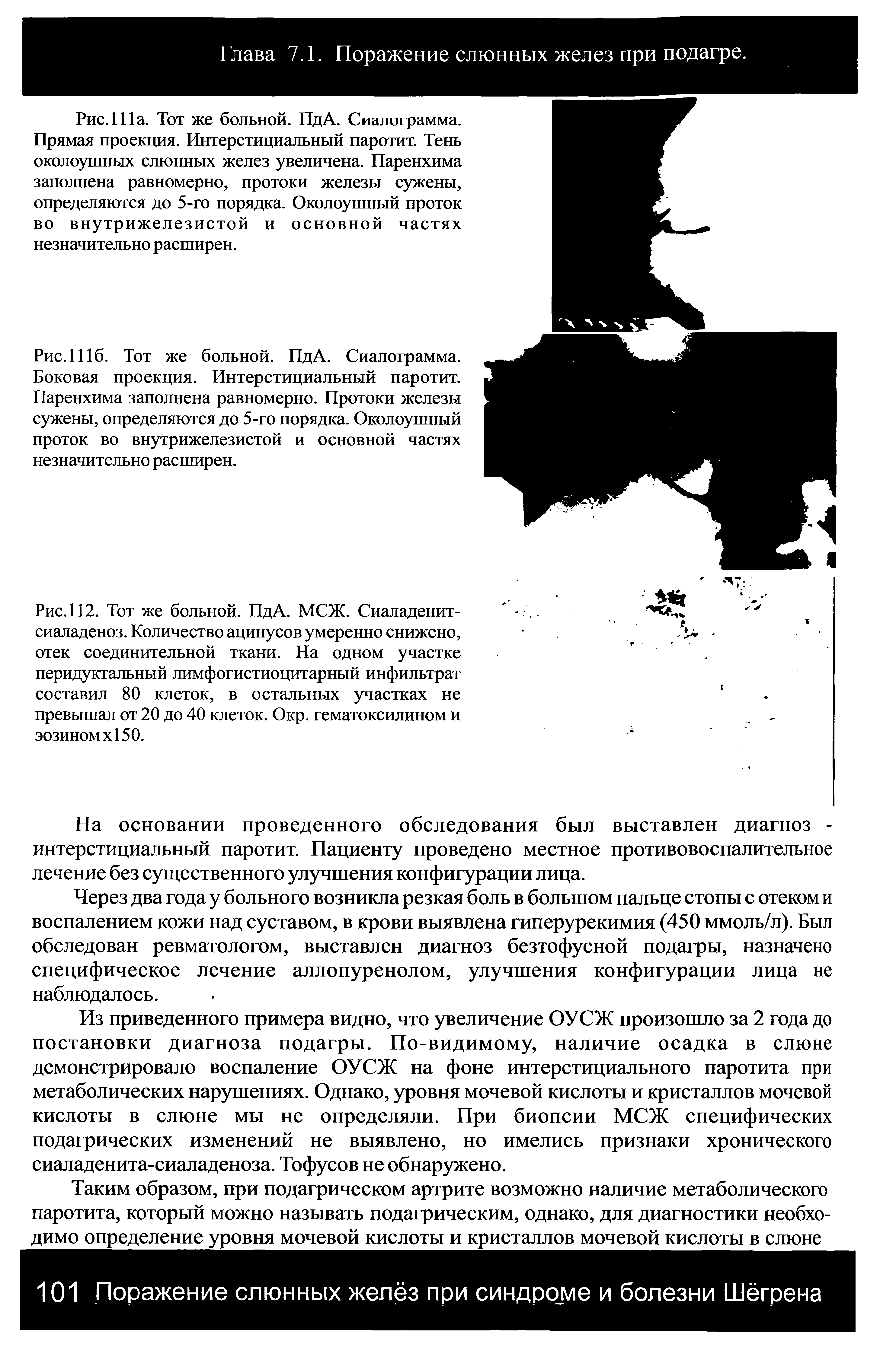 Рис. 112. Тот же больной. ПдА. МСЖ. Сиаладенит-сиаладеноз. Количество ацинусов умеренно снижено, отек соединительной ткани. На одном участке перидуктальный лимфогистиоцитарный инфильтрат составил 80 клеток, в остальных участках не превышал от 20 до 40 клеток. Окр. гематоксилином и эозином х 150.