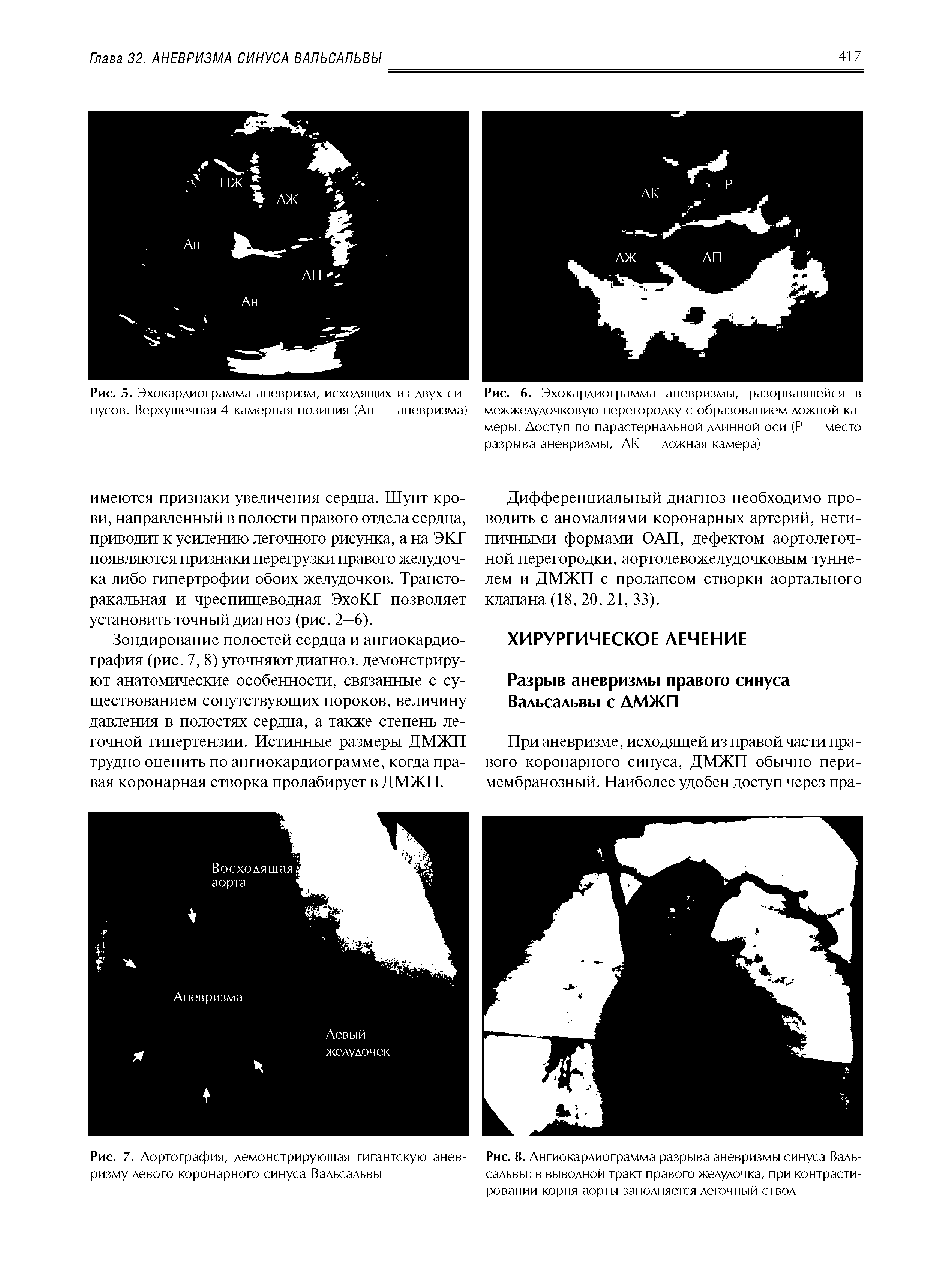 Рис. 6. Эхокардиограмма аневризмы, разорвавшейся в межжелудочковую перегородку с образованием ложной камеры. Доступ по парастернальной длинной оси (Р — место разрыва аневризмы, ЛК — ложная камера)...