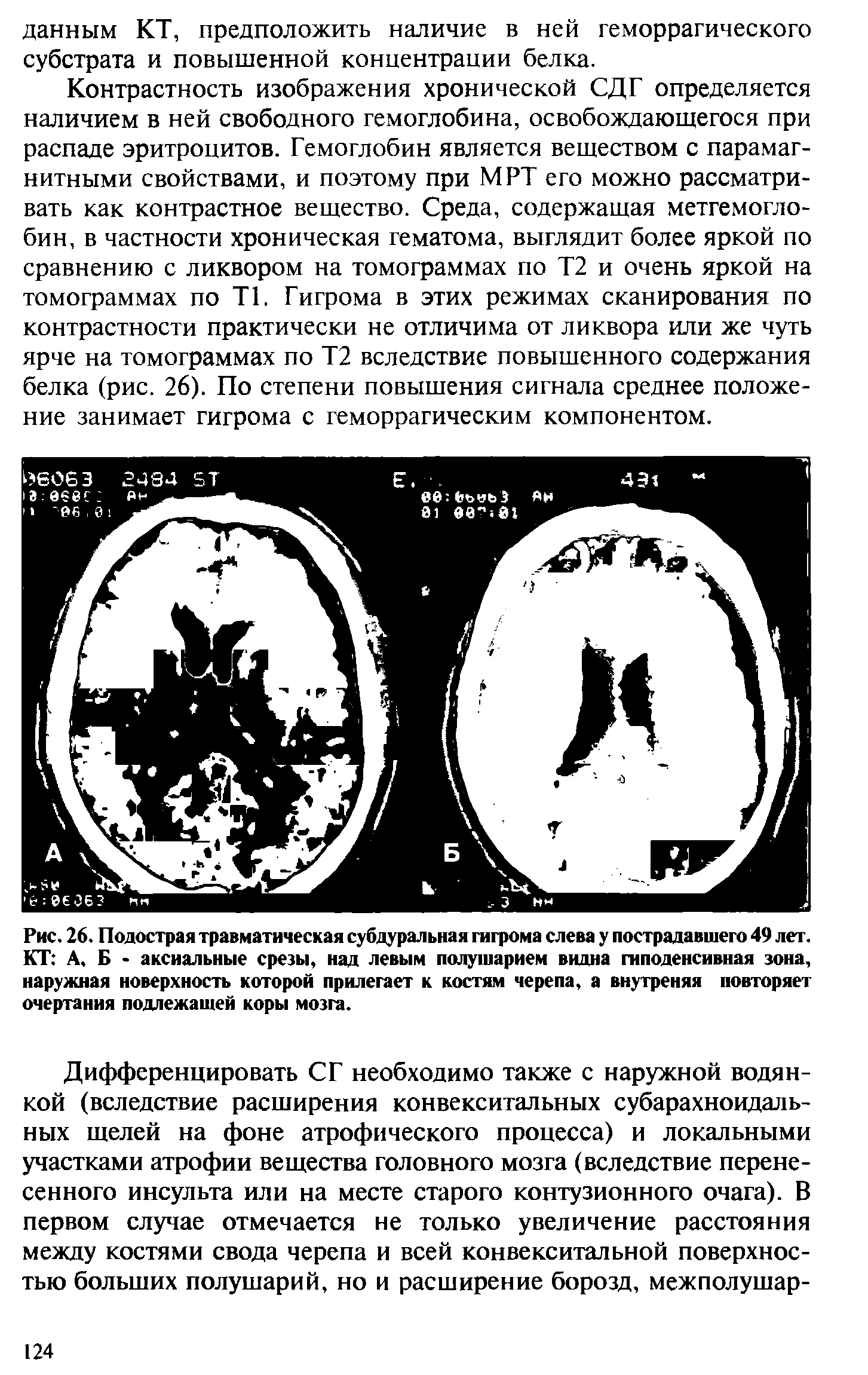 Рис. 26. Подострая травматическая субдуральная гигрома слева у пострадавшего 49 лет. КТ А, Б - аксиальные срезы, над левым полушарием видна гиподенсивная зона, наружная поверхность которой прилегает к костям черепа, а внутреняя повторяет очертания подлежащей коры мозга.