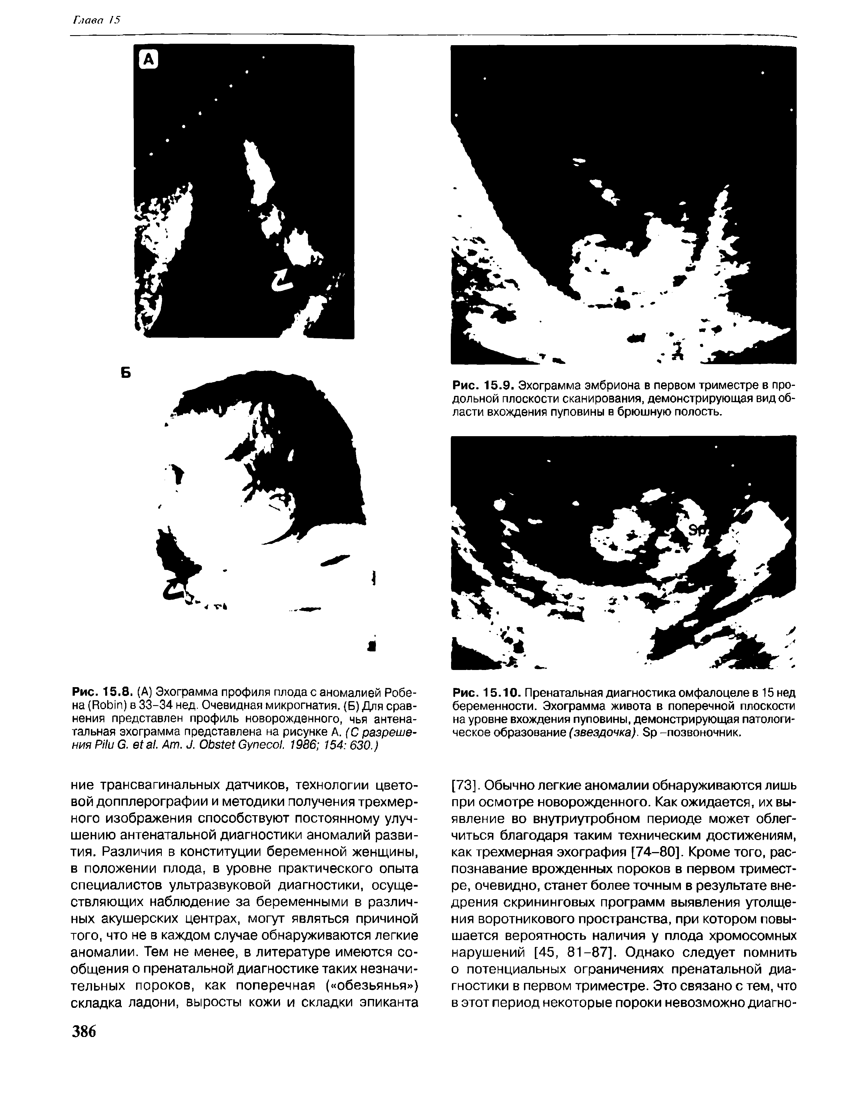 Рис. 15.9. Эхограмма эмбриона в первом триместре в продольной плоскости сканирования, демонстрирующая вид области вхождения пуповины в брюшную полость.