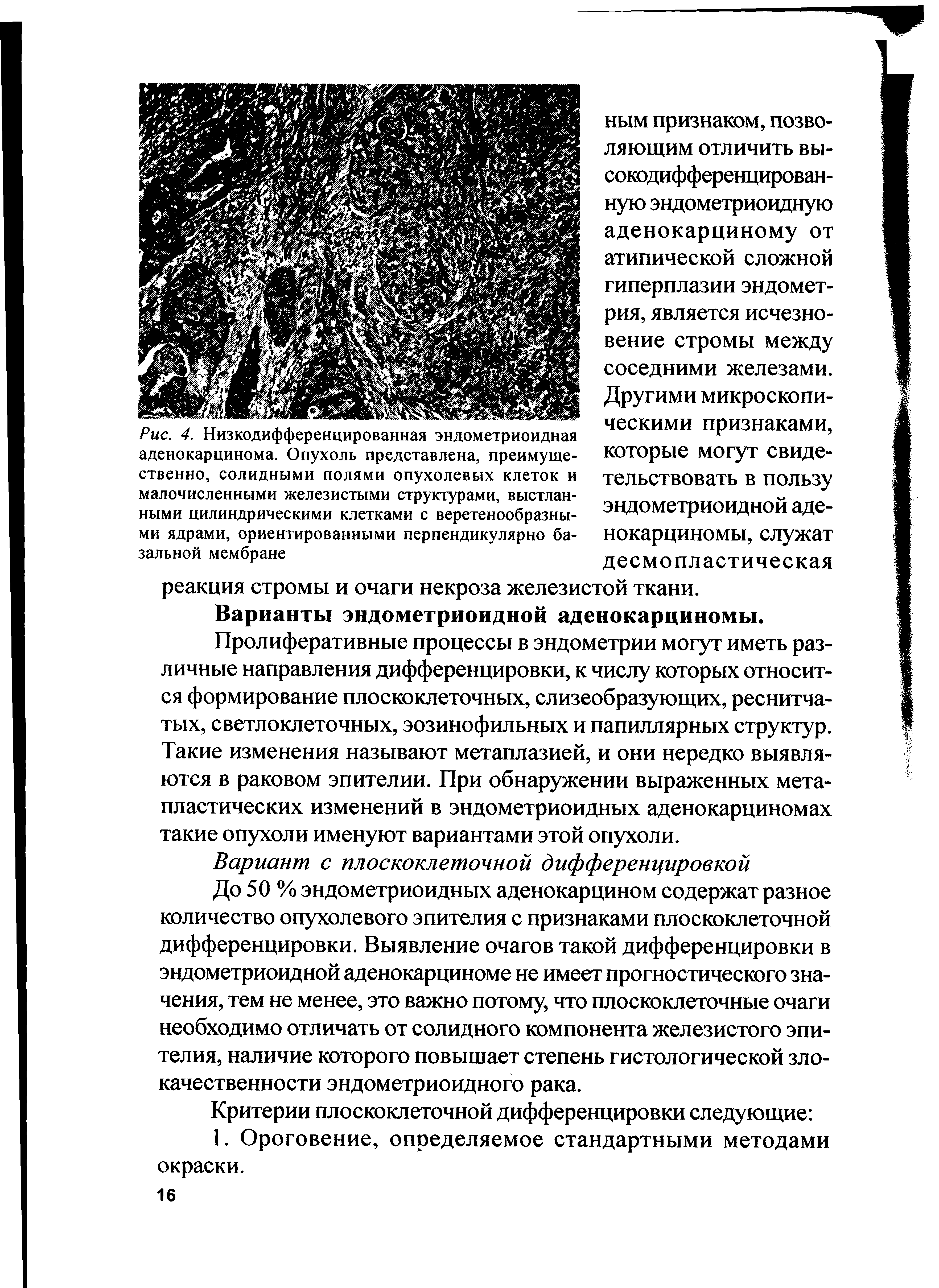 Рис. 4. Низкодифференцированная эндометриоидная аденокарцинома. Опухоль представлена, преимущественно, солидными полями опухолевых клеток и малочисленными железистыми структурами, выстланными цилиндрическими клетками с веретенообразными ядрами, ориентированными перпендикулярно базальной мембране...