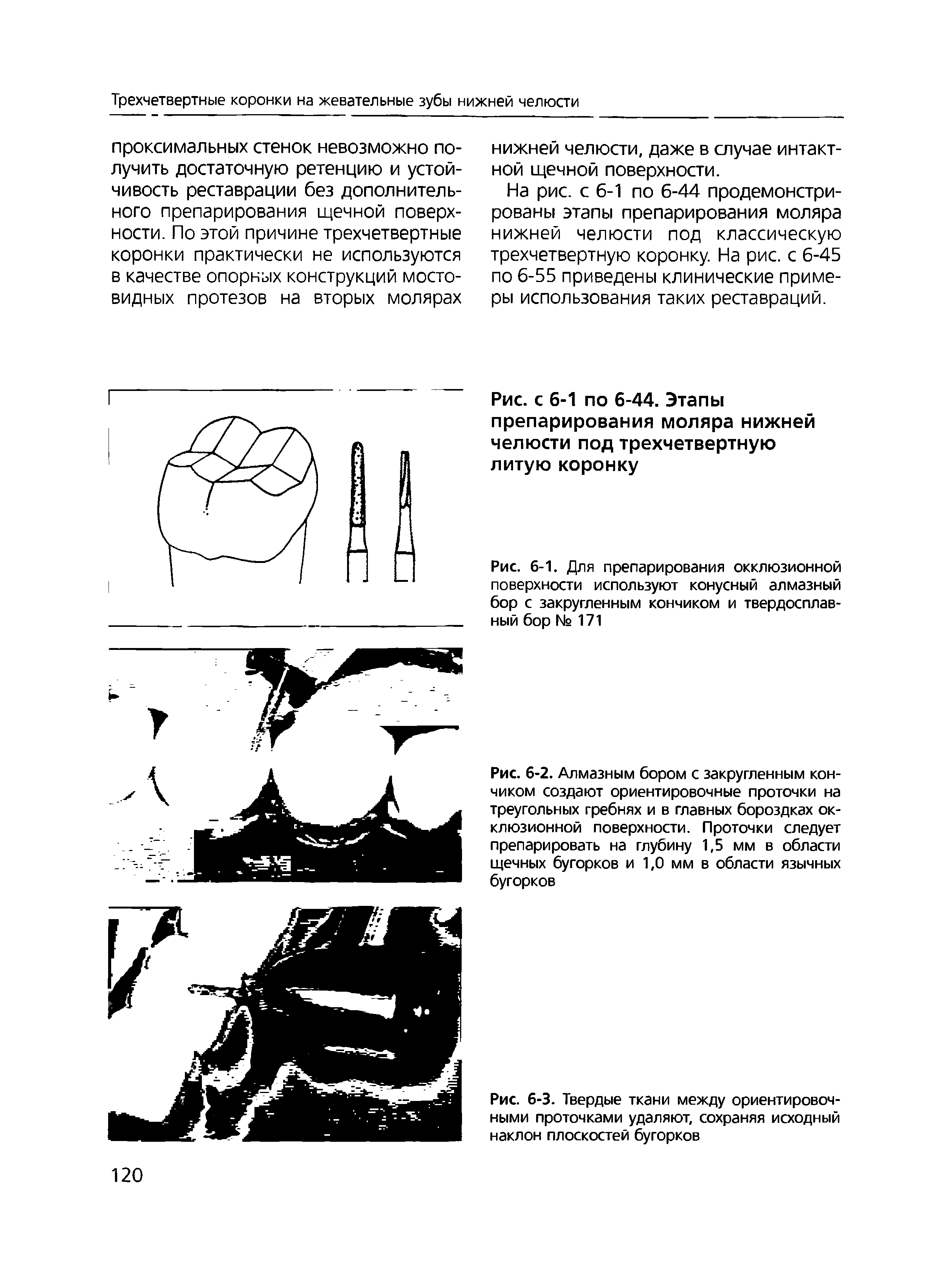 Рис. 6-1. Для препарирования окклюзионной поверхности используют конусный алмазный бор с закругленным кончиком и твердосплавный бор № 171...
