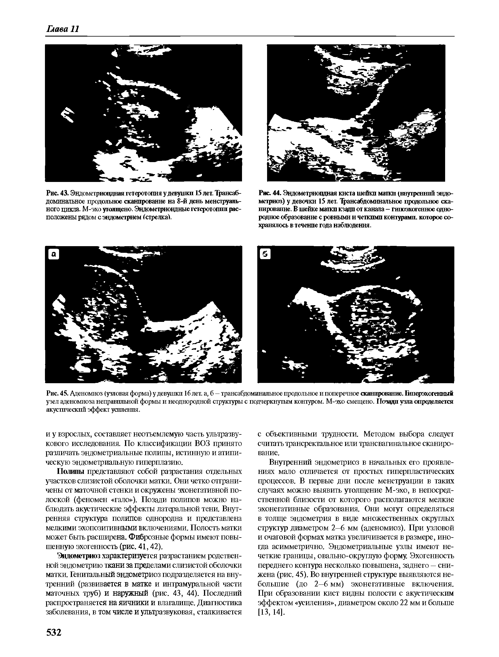 Рис. 44. Эцдометриоццная киста шейки матки (внутренний эндометриоз) у девочки 15 лет. Трансабдоминальное продольное сканирование. В шейке маткп кзади от канала - гипоэхогенное однородное образование с ровными и четкими контурами, которое сохранялось в течение года наблюдения.