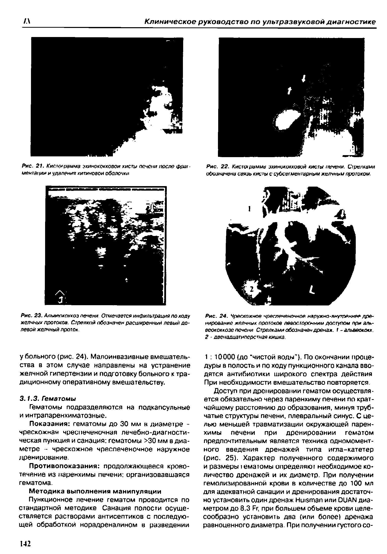 Рис. 23. Альвеококкоз пенеми Отмечается инфильтрация по ходу желчных лротокоа. Стрелкой обозначен расширенный левый долевой желчный проток.