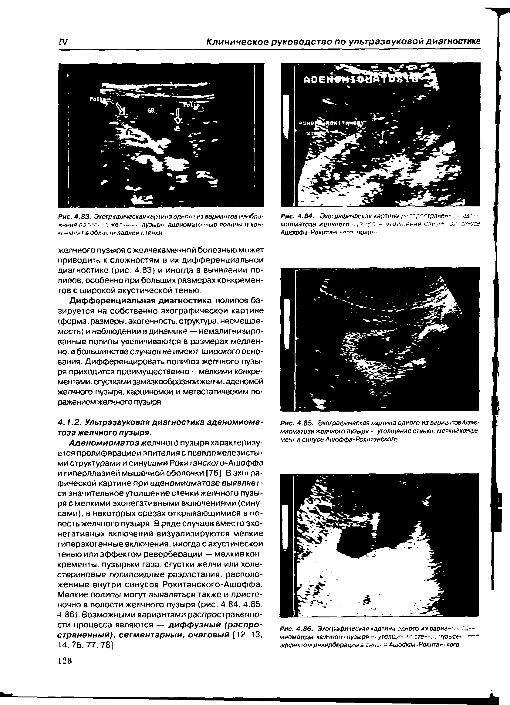 Рис. 4.85. Эхографическая хар/ила одного из веингчтоеадан -мхомаюза желчного пузыри - утолщение стенки. мелкийколкое-меьч синусе Л доффу- оки72нского...