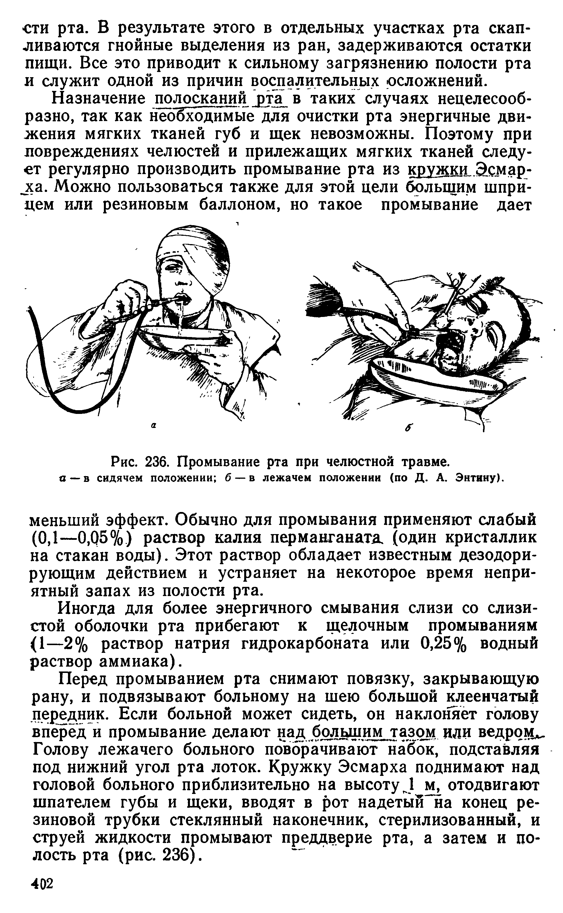 Рис. 236. Промывание рта при челюстной травме, а —в сидячем положении б —в лежачем положении (по Д. А. Энтину).