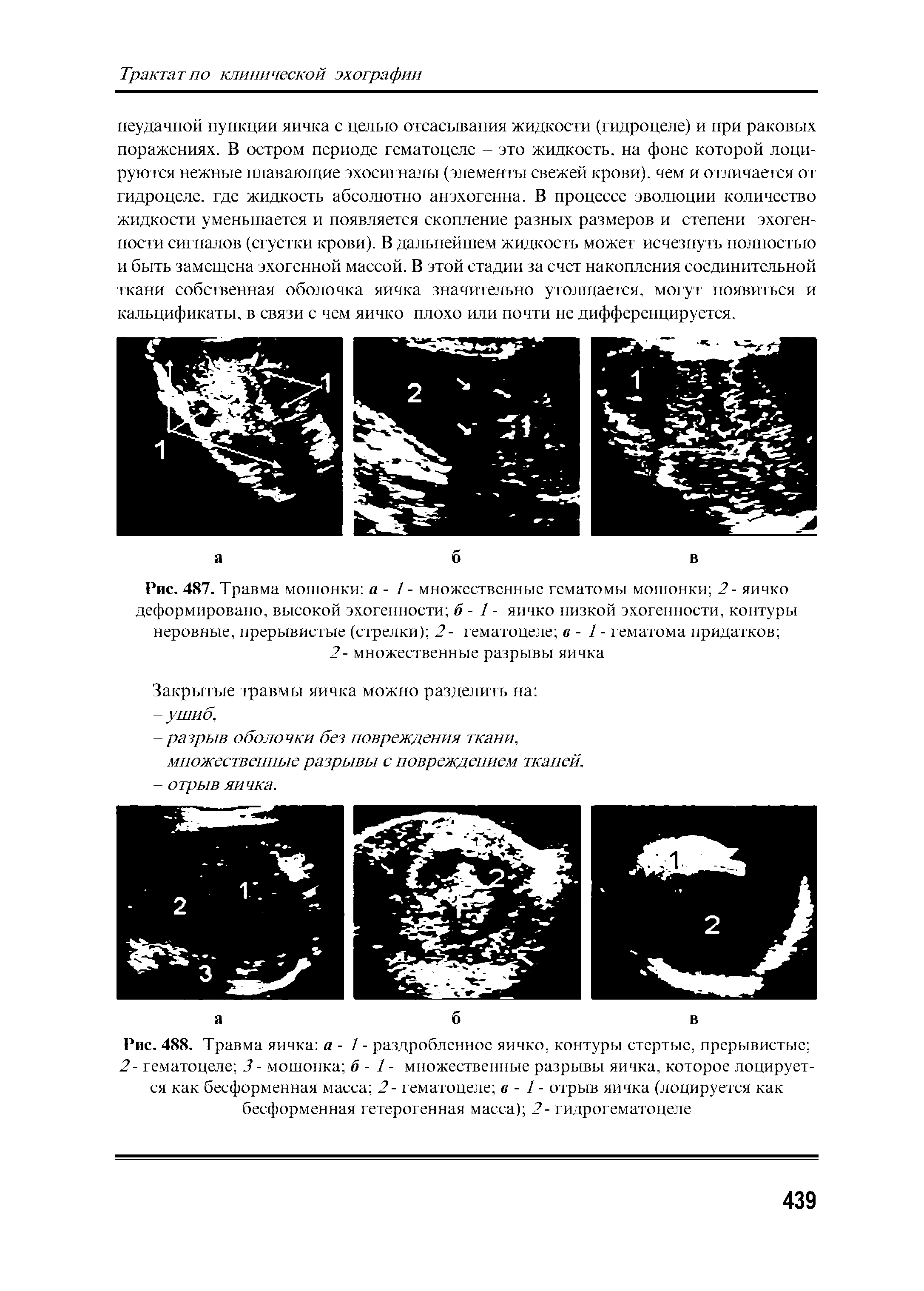 Рис. 487. Травма мошонки а - 1 - множественные гематомы мошонки 2- яичко деформировано, высокой эхогенности б - 1 - яичко низкой эхогенности, контуры неровные, прерывистые (стрелки) 2- гематоцеле в - 1 - гематома придатков 2- множественные разрывы яичка...