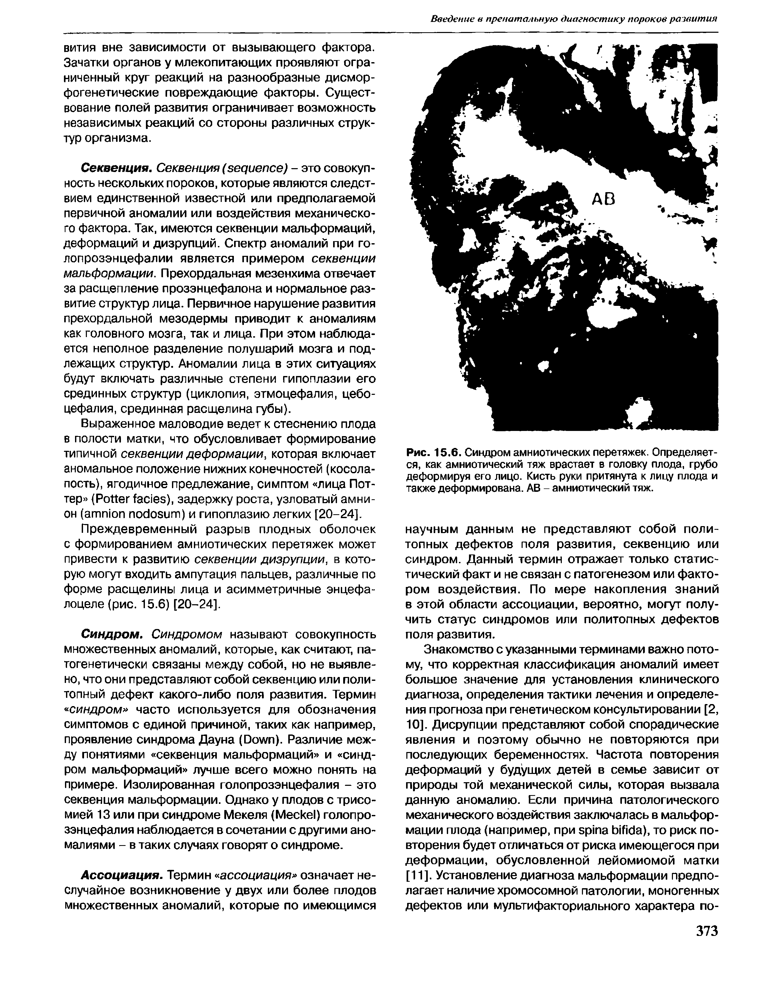 Рис. 15.6. Синдром амниотических перетяжек. Определяется, как амниотический тяж врастает в головку плода, грубо деформируя его лицо. Кисть руки притянута к лицу плода и также деформирована. АВ - амниотический тяж.