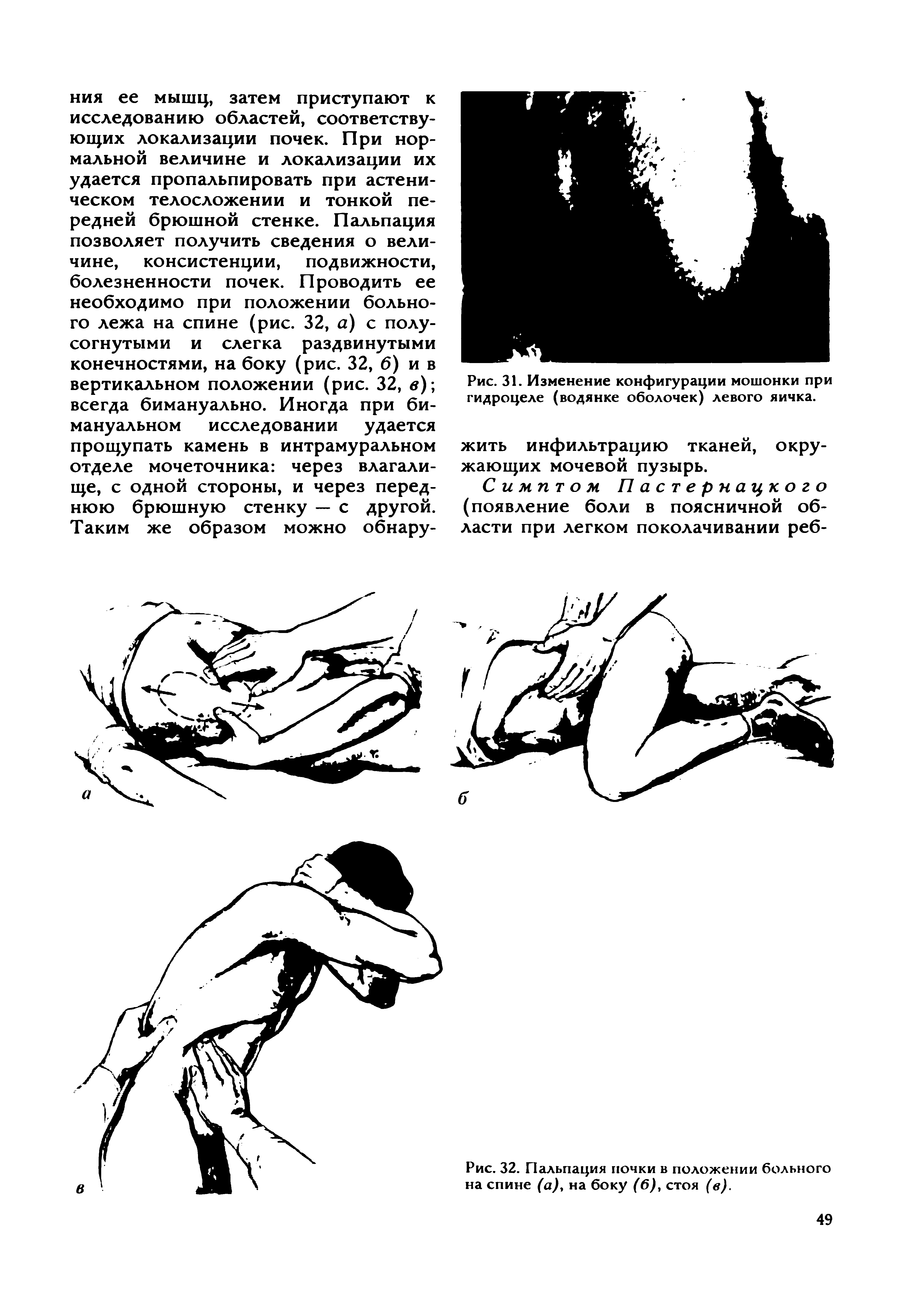 Рис. 31. Изменение конфигурации мошонки при гидроцеле (водянке оболочек) левого яичка.