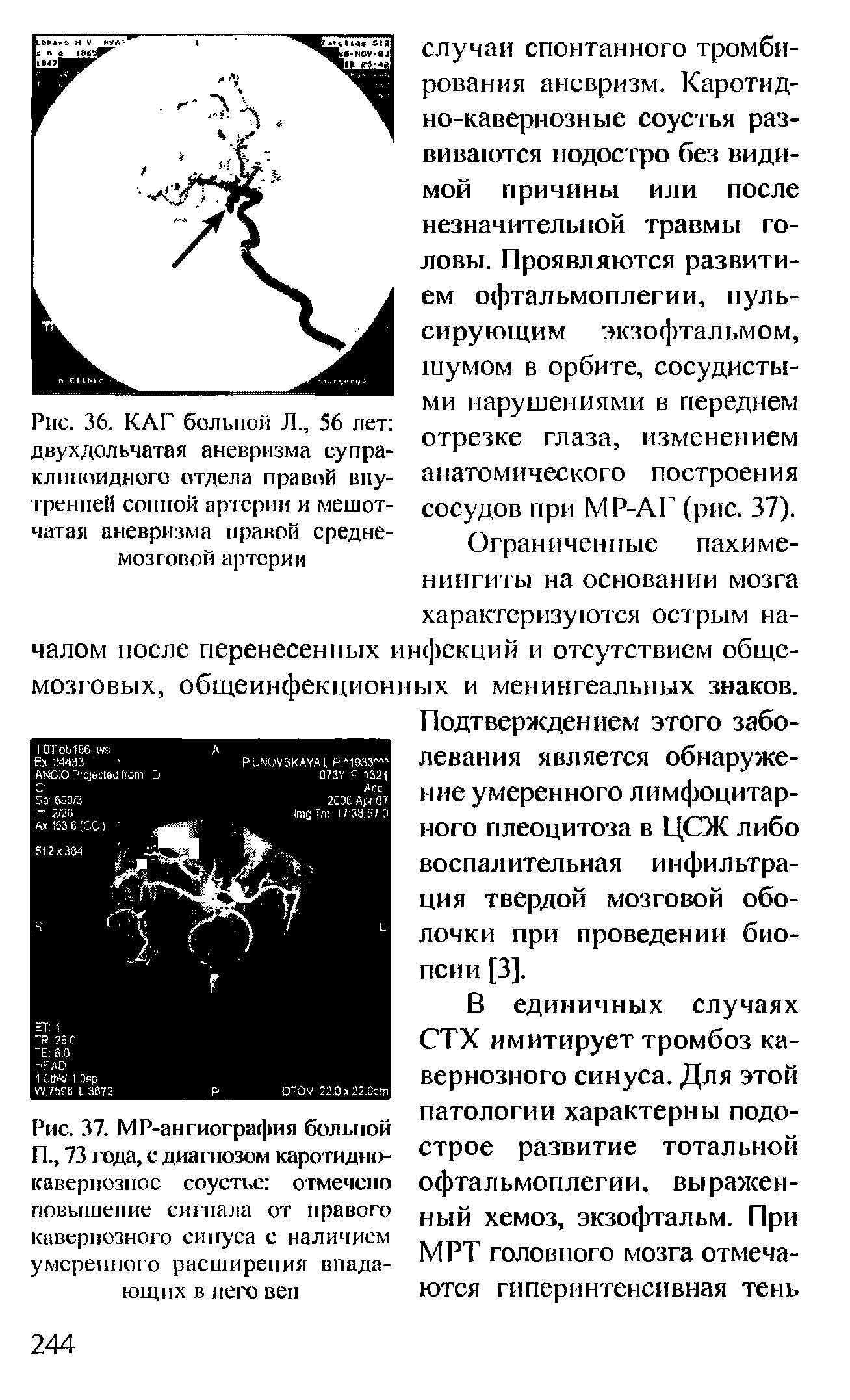 Рис. 37. МР-ангиография больной ГЕ, 73 года, с диагнозом каротиднокавернозное соустье отмечено повышение сигнала от правого кавернозного синуса с наличием умеренного расширения впадающих в него вен...