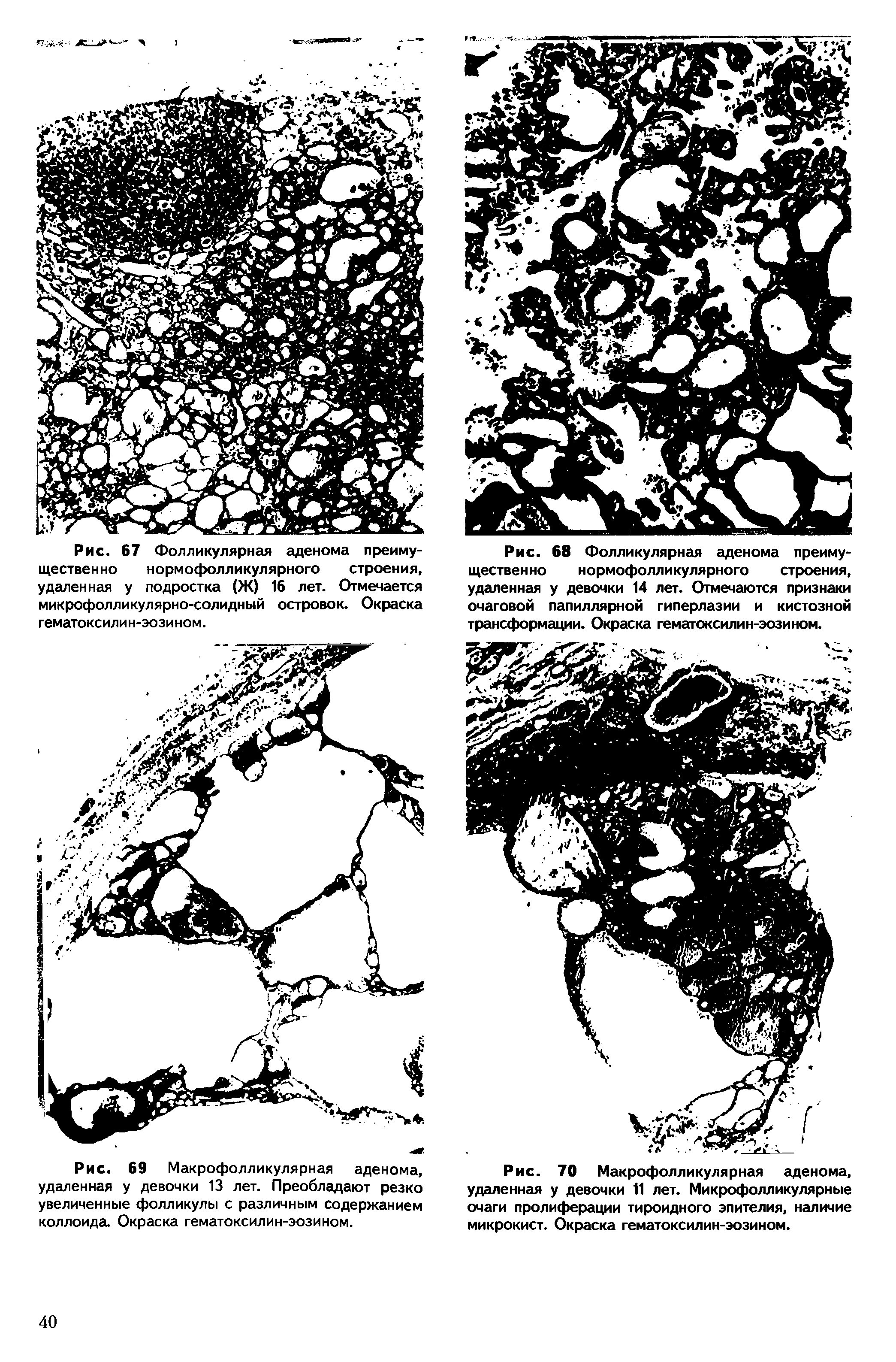 Рис. 70 Макрофолликулярная аденома, удаленная у девочки 11 лет. Микрофолликулярные очаги пролиферации тироидного эпителия, наличие микрокист. Окраска гематоксилин-эозином.