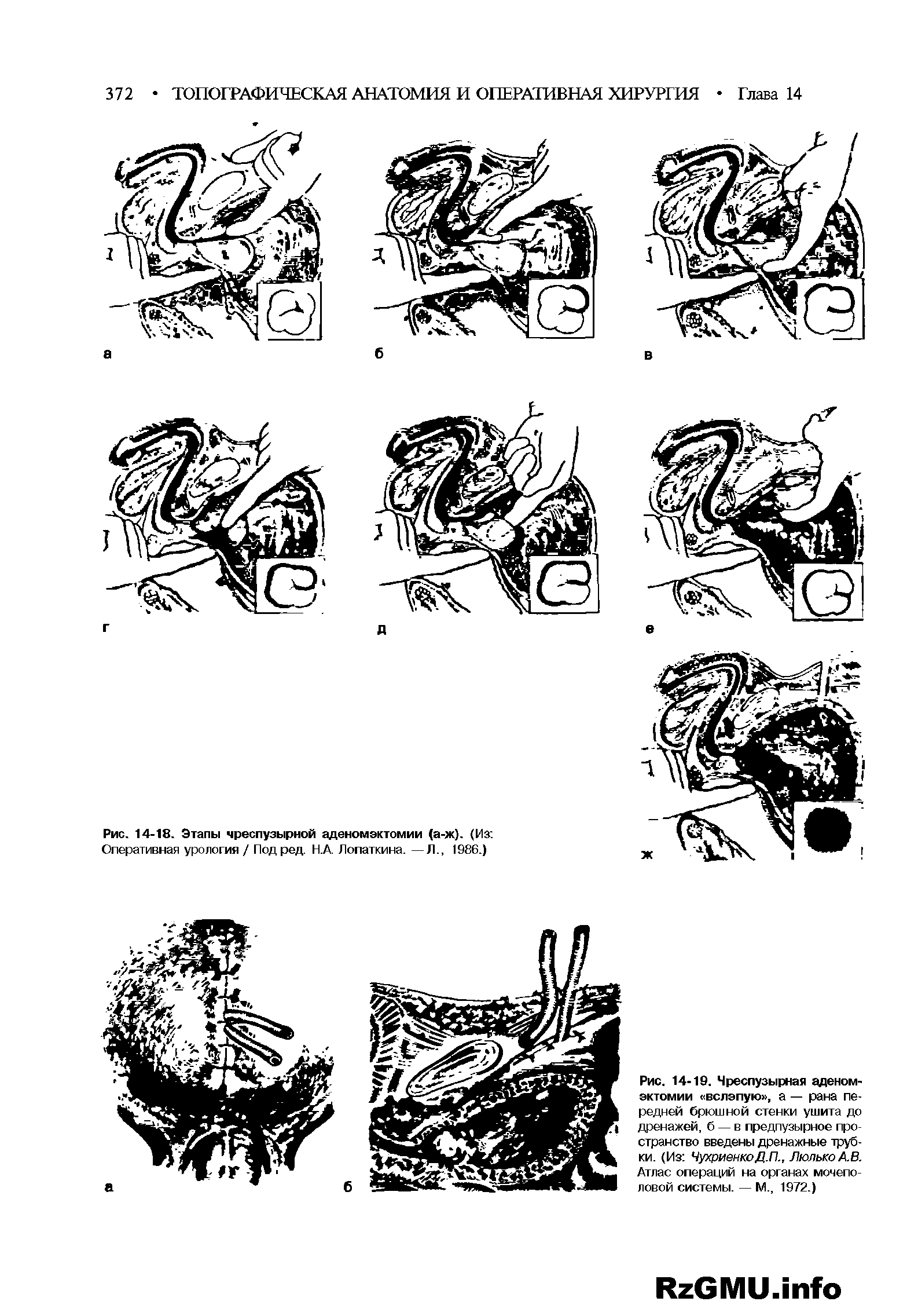 Рис. 14-19. Чреспузырная аденомэктомии вслепую , а — рана передней брюшной стенки ушита до дренажей, б — в предпузырное пространство введены дренажные трубки. (Из ЧухриенкоД.П., ЛюлькоА.В. Атлас операций на органах мочеполовой системы. — М., 1972.)...