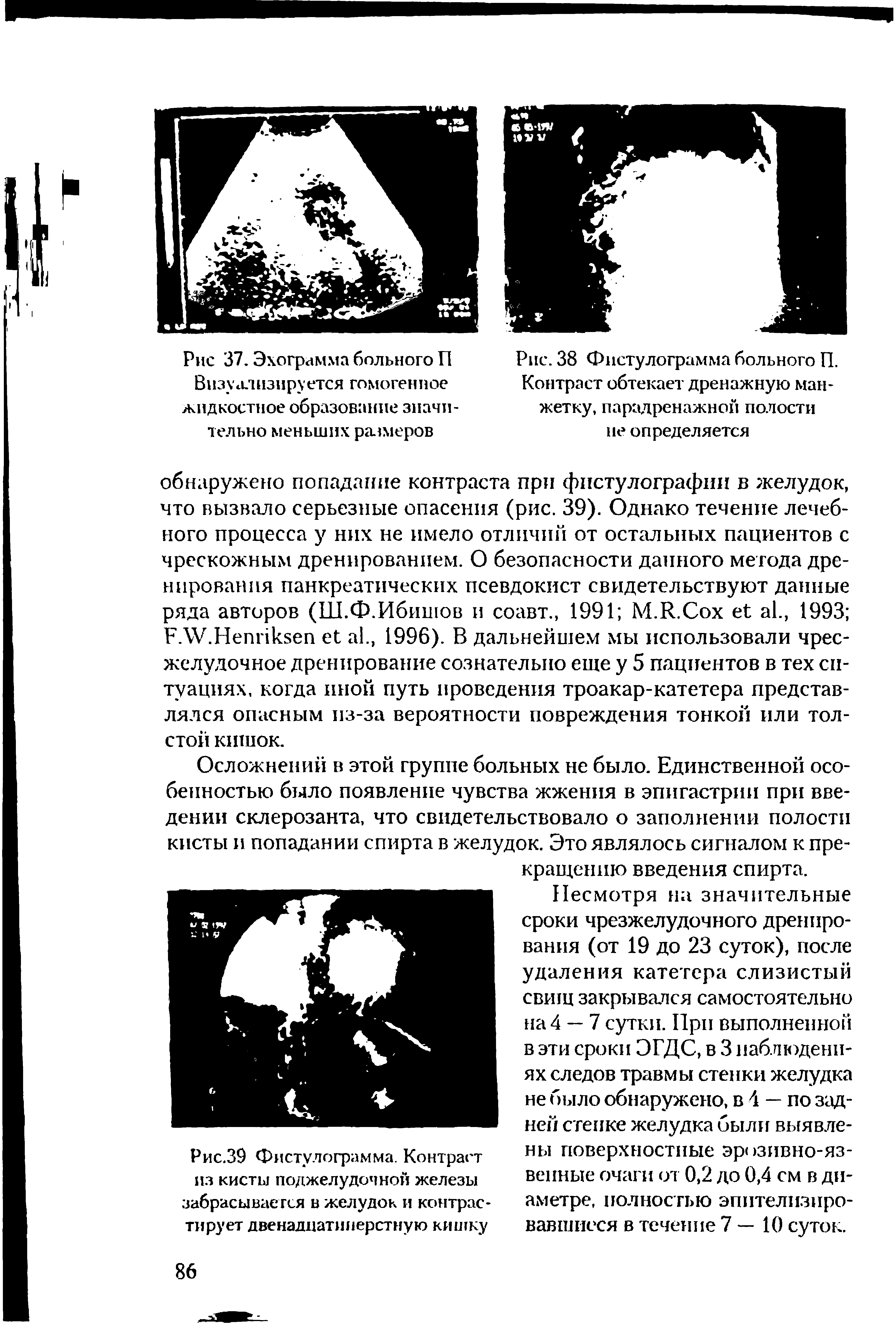 Рис.39 Фистулограмма. Контраст из кисты поджелудочной железы забрасывается в желудок и контрастирует двенадцатиперстную кишку...