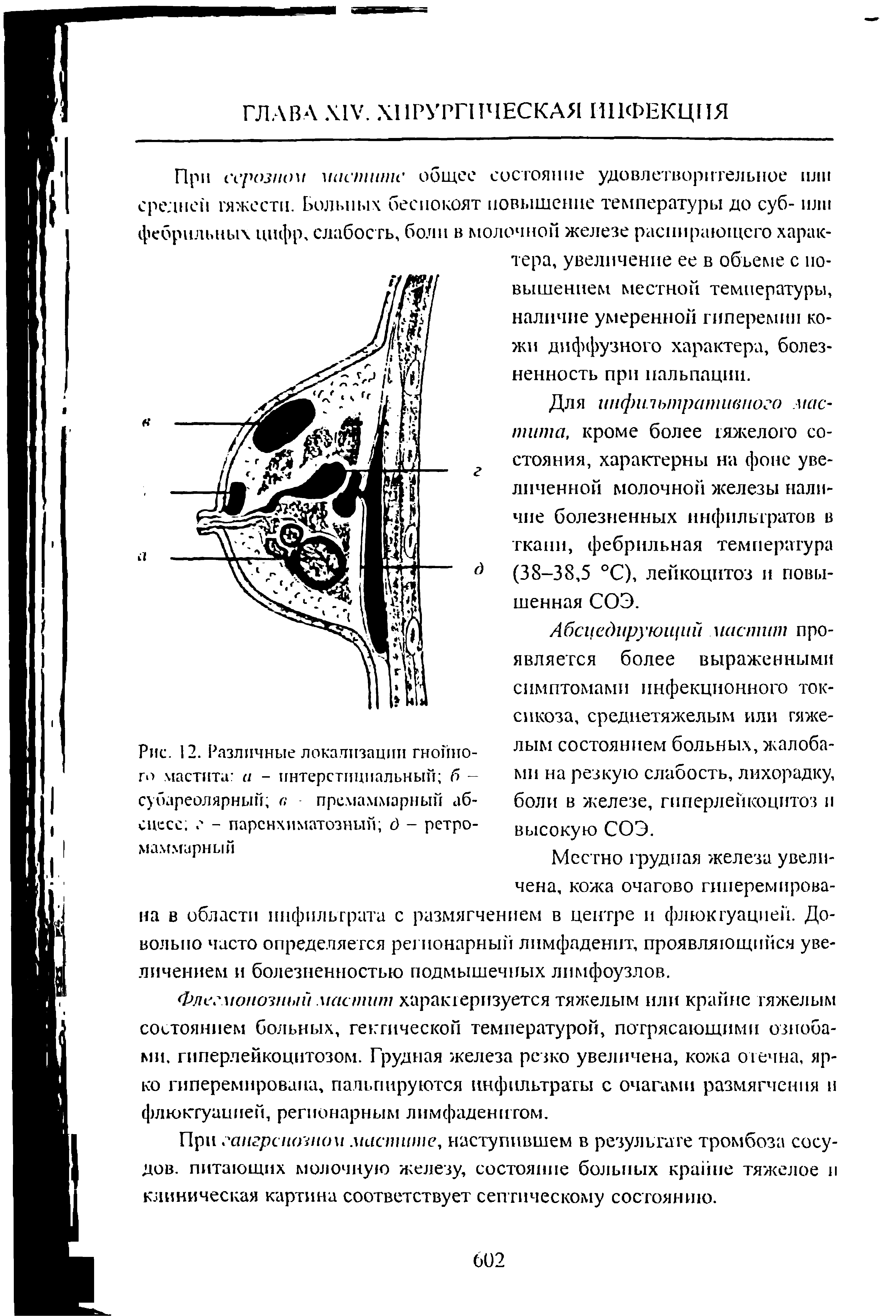 Рис. 12. Различные локализации гнойного мастита а - интерстициальный б -субареолярный а премаммарный абсцесс г - паренхиматозный д - ретро-маммарный...