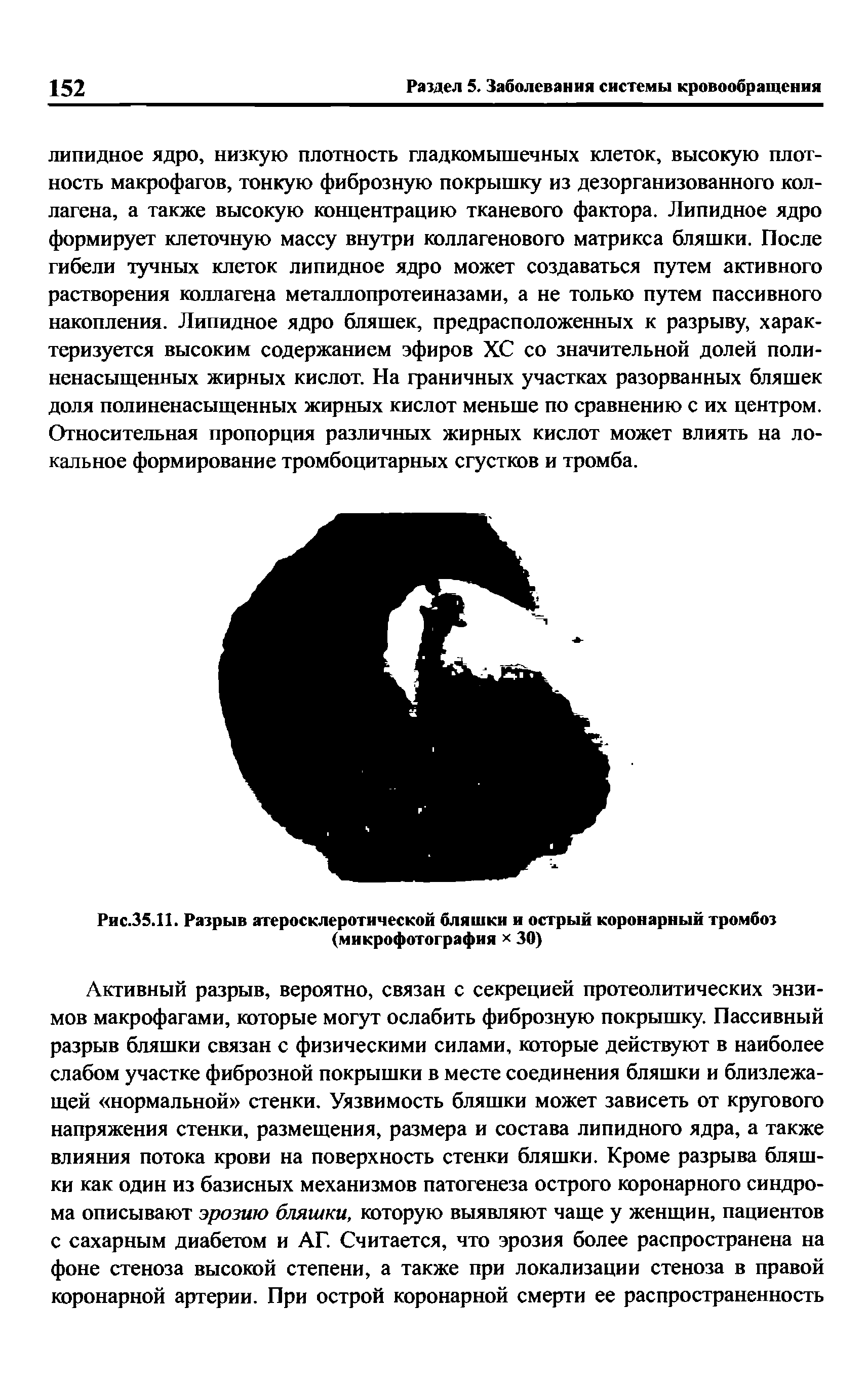 Рис.35.П. Разрыв атеросклеротической бляшки и острый коронарный тромбоз (микрофотография 30)...