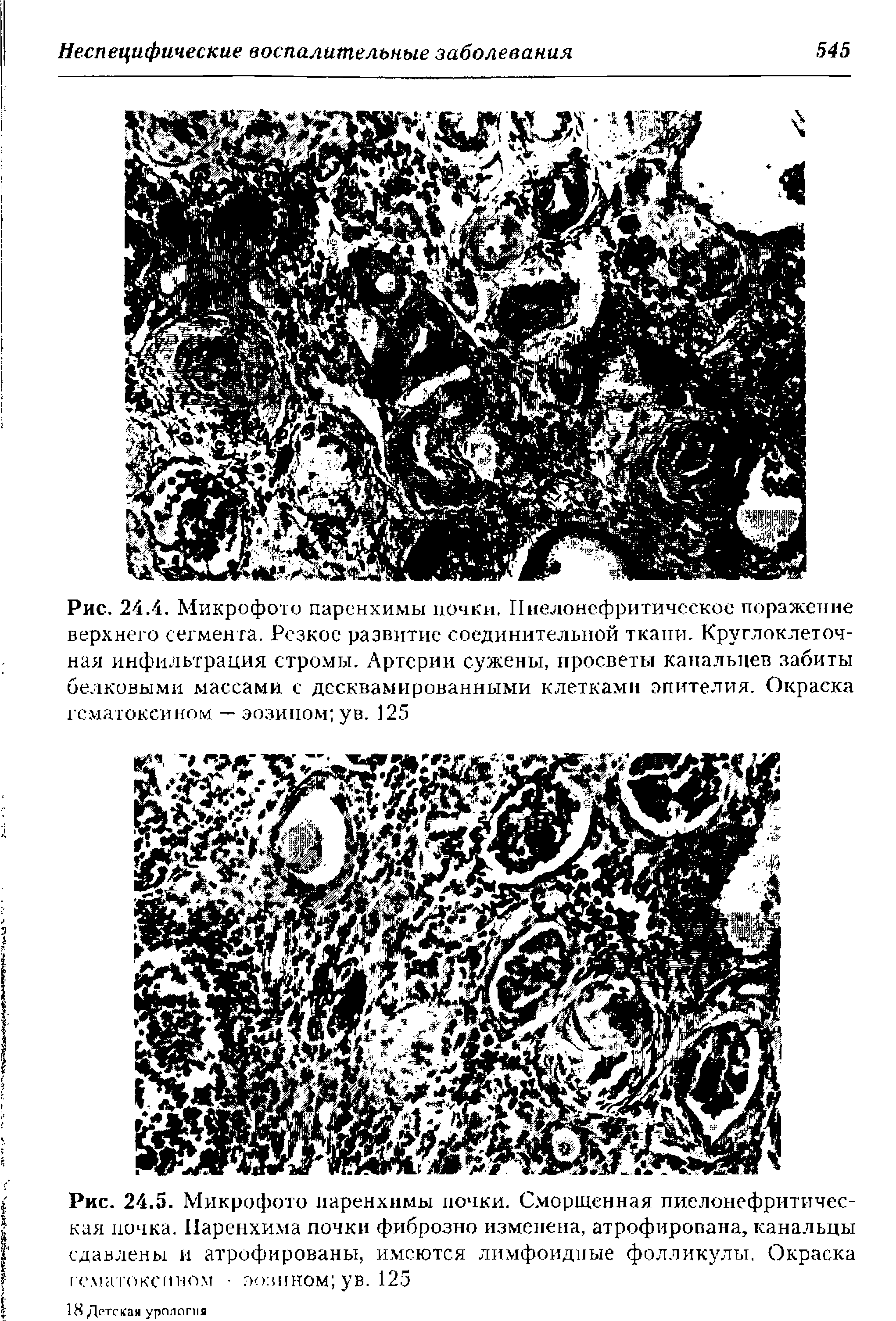 Рис. 24.5. Микрофото паренхимы почки. Сморщенная пиелонефритичес-кая почка. Паренхима почки фиброзно изменена, атрофирована, канальцы сдавлены и атрофированы, имеются лимфоидные фолликулы. Окраска гсмагоксином эозином ув. 125...