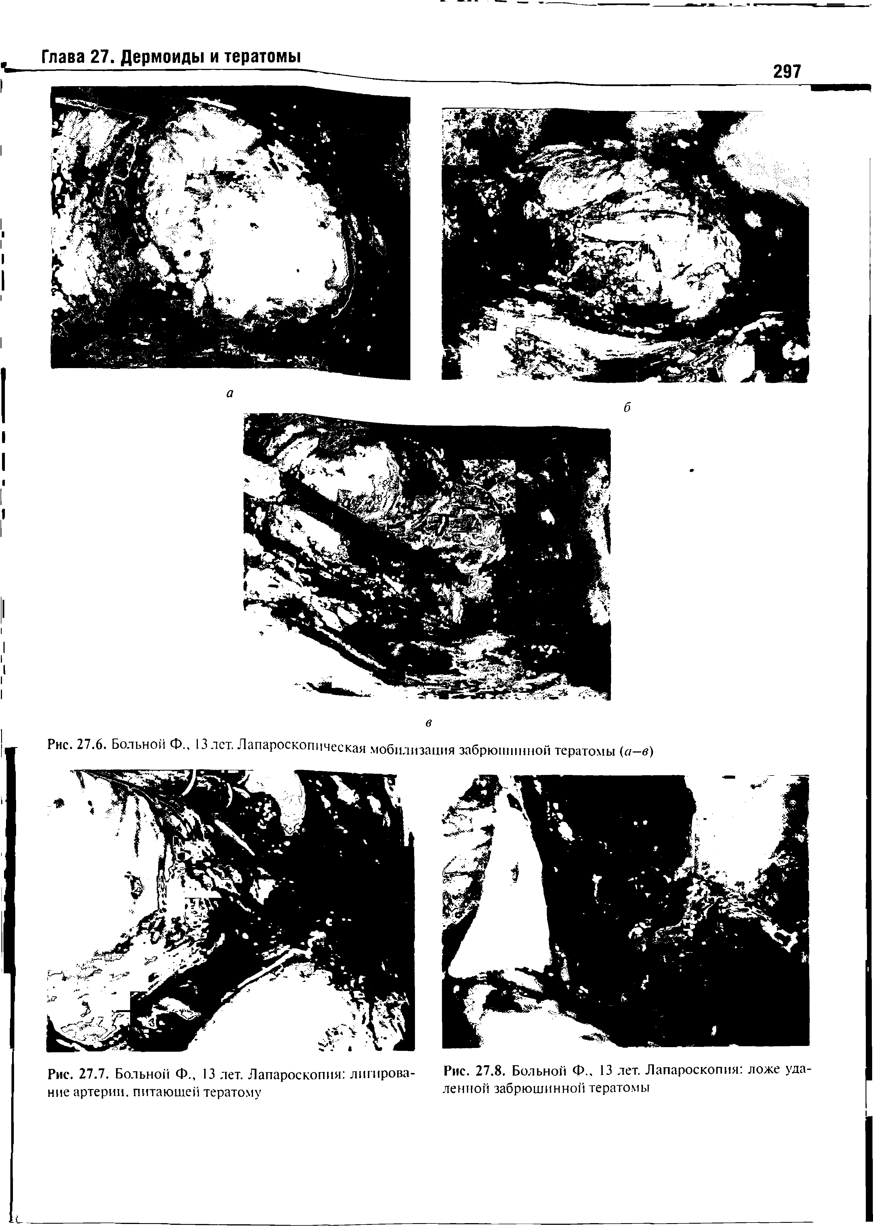 Рис. 27.8. Больной Ф., 13 лет. Лапароскопия ложе уда ленной забрюшинной тератомы...