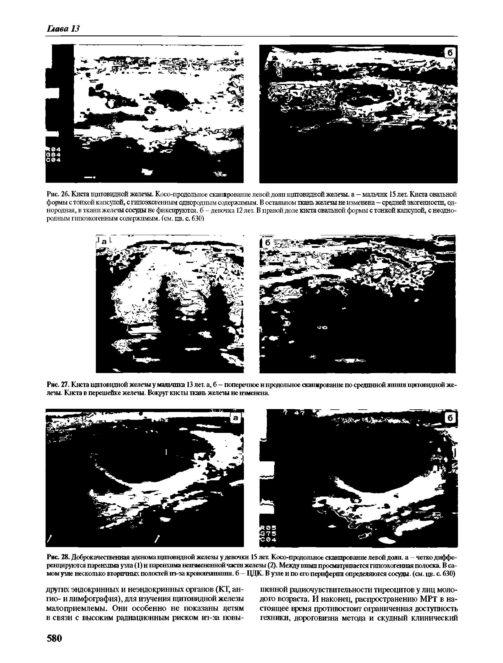 Рис. 27. Киста щитовидной железы у мальчика 13 лет. а, б - поперечное и продольное сжанжрование по срединной линии щитовидной железы. Киста в перешейке железы. Вокруг кисты ткань железы не изменена.