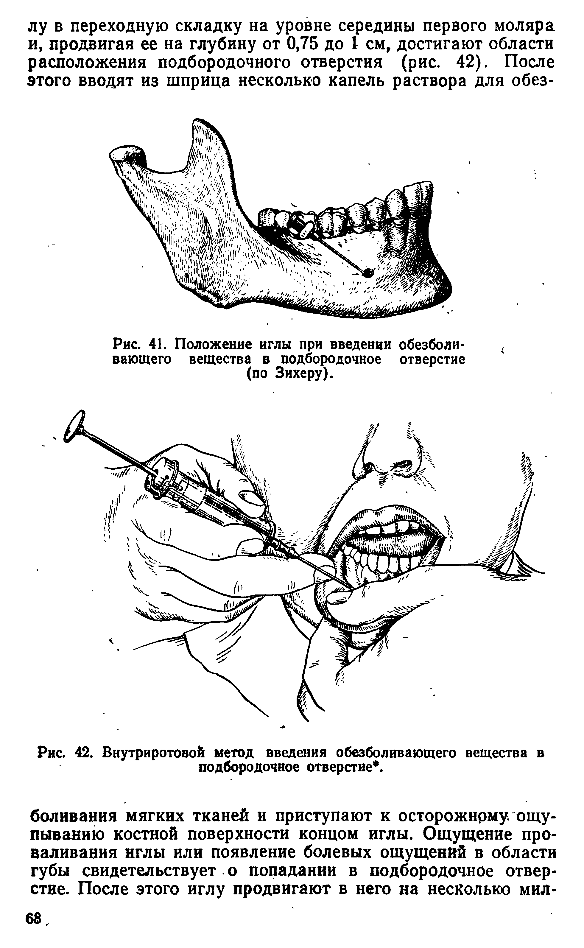 Рис. 42. Внутриротовой метод введения обезболивающего вещества в подбородочное отверстие. ...