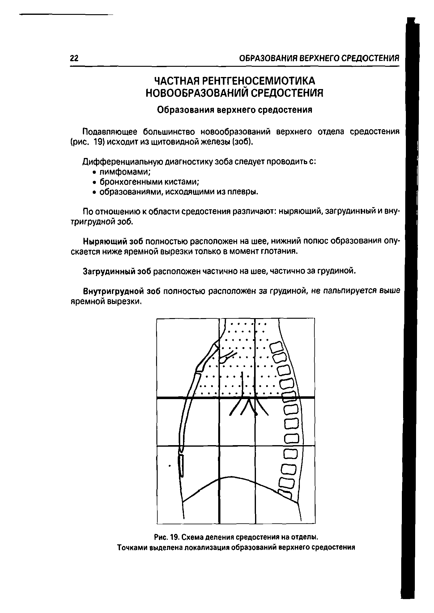 Рис. 19. Схема деления средостения на отделы. Точками выделена локализация образований верхнего средостения...