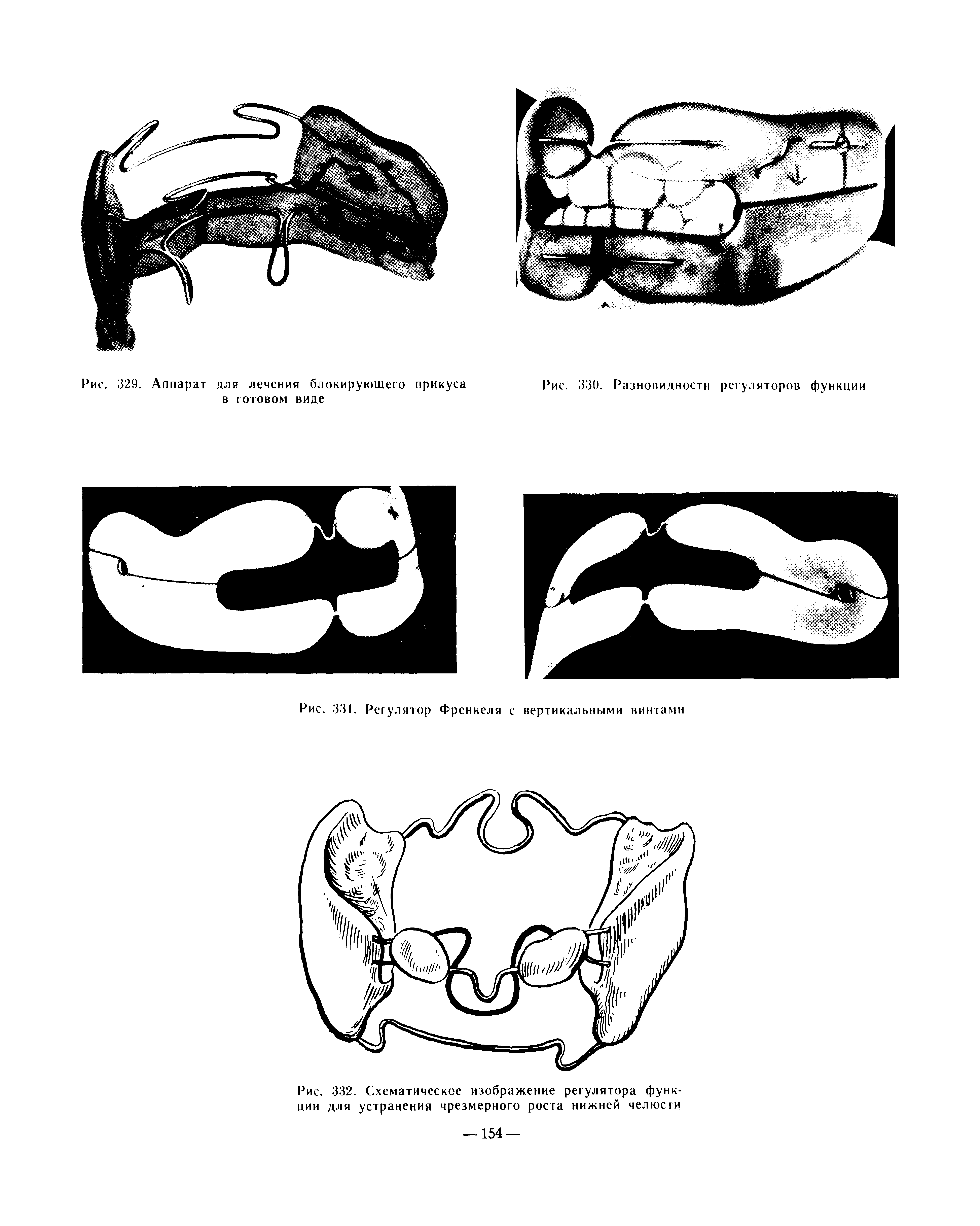 Рис. 332. Схематическое изображение регулятора функции для устранения чрезмерного роста нижней челюсти...