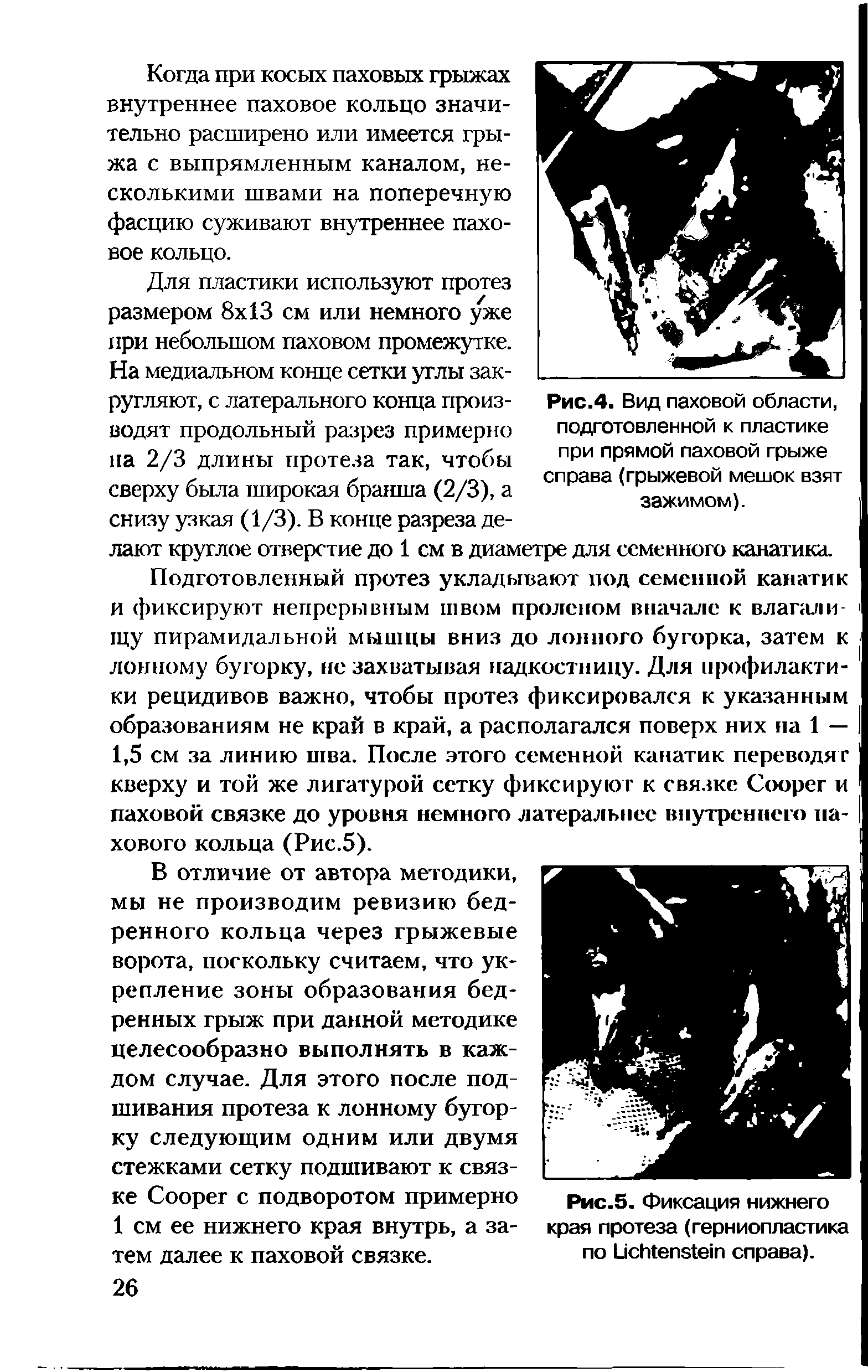 Рис.5. Фиксация нижнего края протеза (герниопластика по L справа).