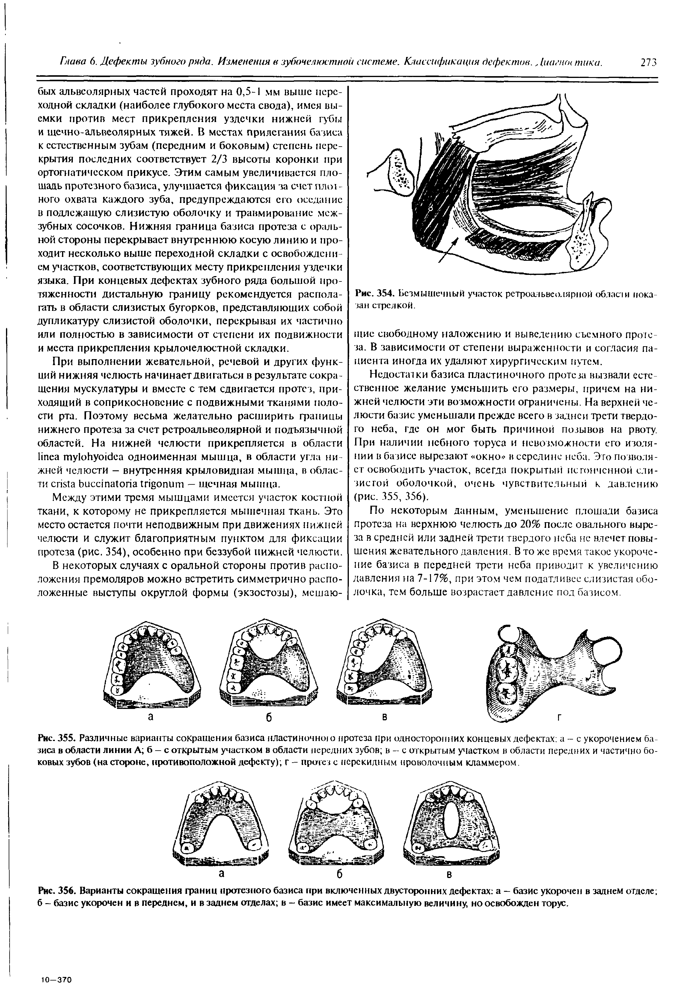 Рис. 356. Варианты сокращения границ протезного базиса при включенных двусторонних дефектах а — базис укорочен в заднем отделе б - базис укорочен и в переднем, и в заднем отделах в - базис имеет максимальную величину, но освобожден торус.