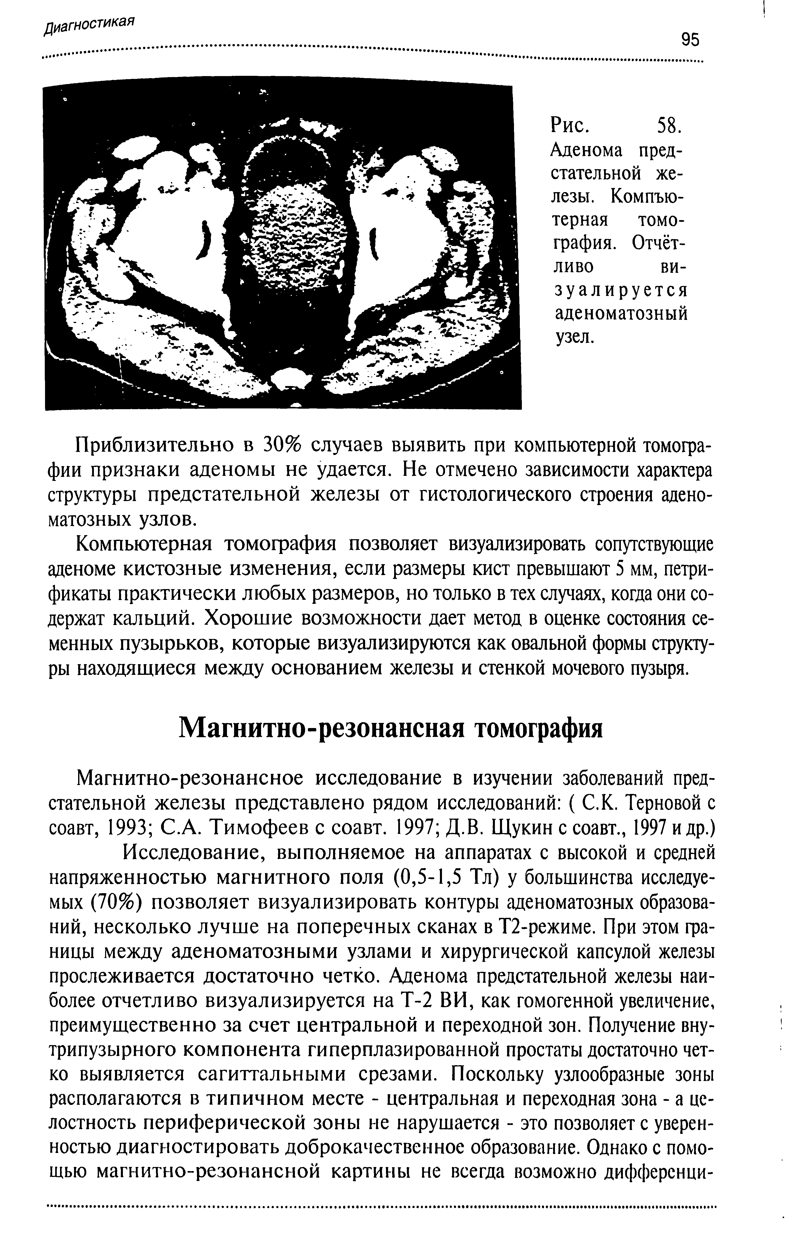 Рис. 58. Аденома предстательной железы. Компьютерная томография. Отчётливо ви-...