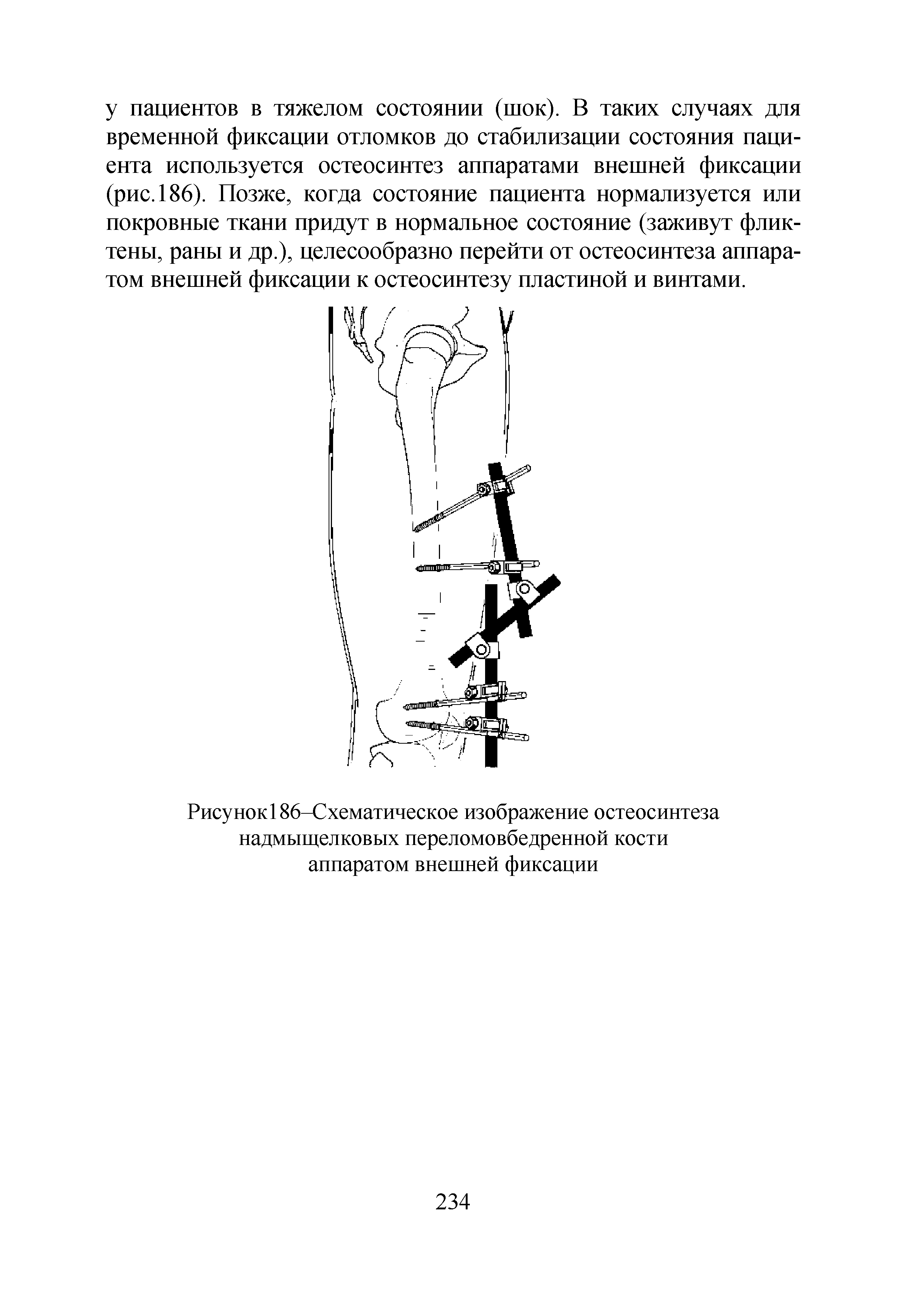 Рисунок186-Схематическое изображение остеосинтеза надмыщелковых переломовбедренной кости аппаратом внешней фиксации...