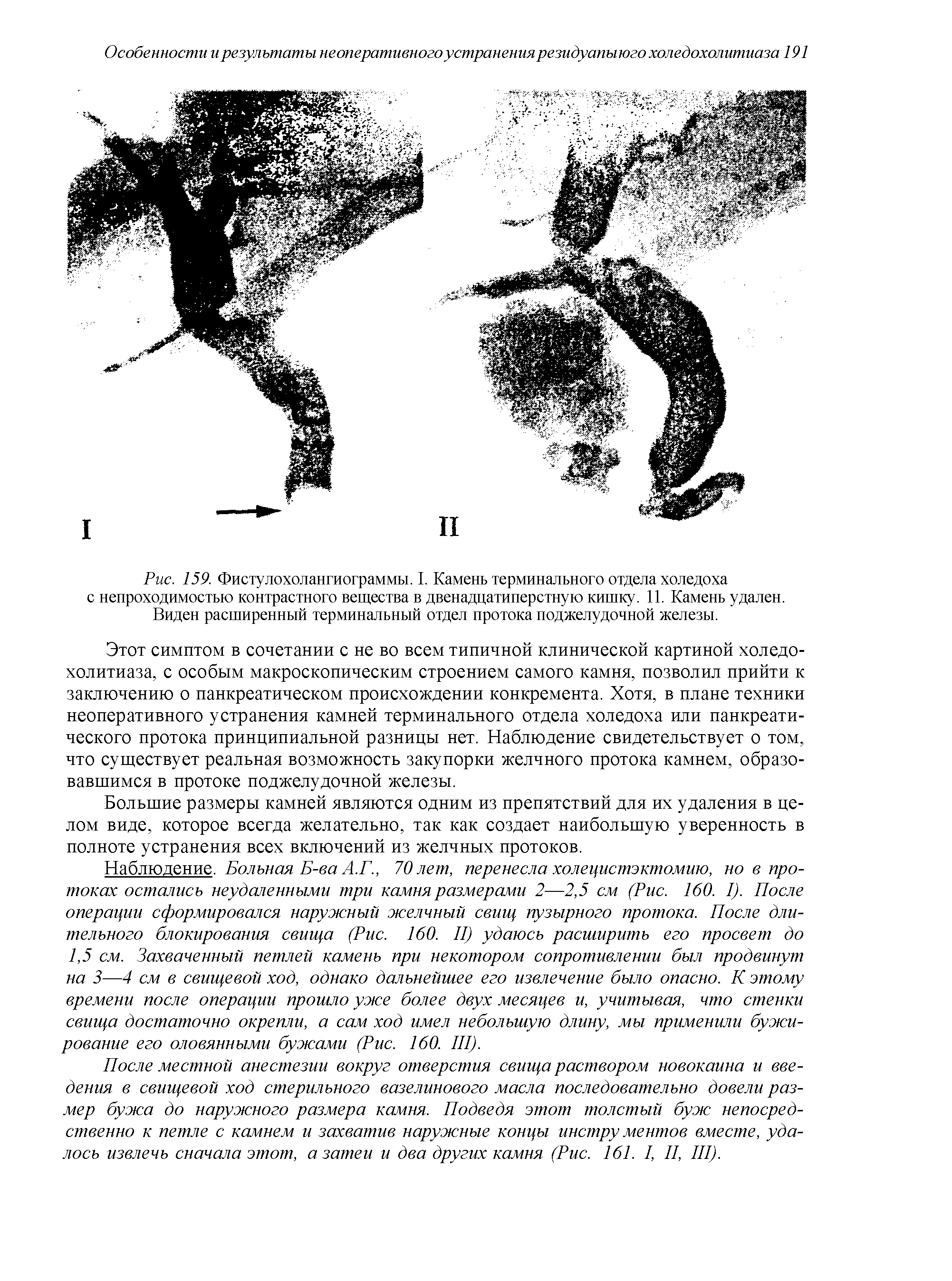 Рис. 159. Фиетулохолангиограммы. I. Камень терминального отдела холедоха с непроходимостью контрастного вещества в двенадцатиперстную кишку. 11. Камень удален. Виден расширенный терминальный отдел протока поджелудочной железы.