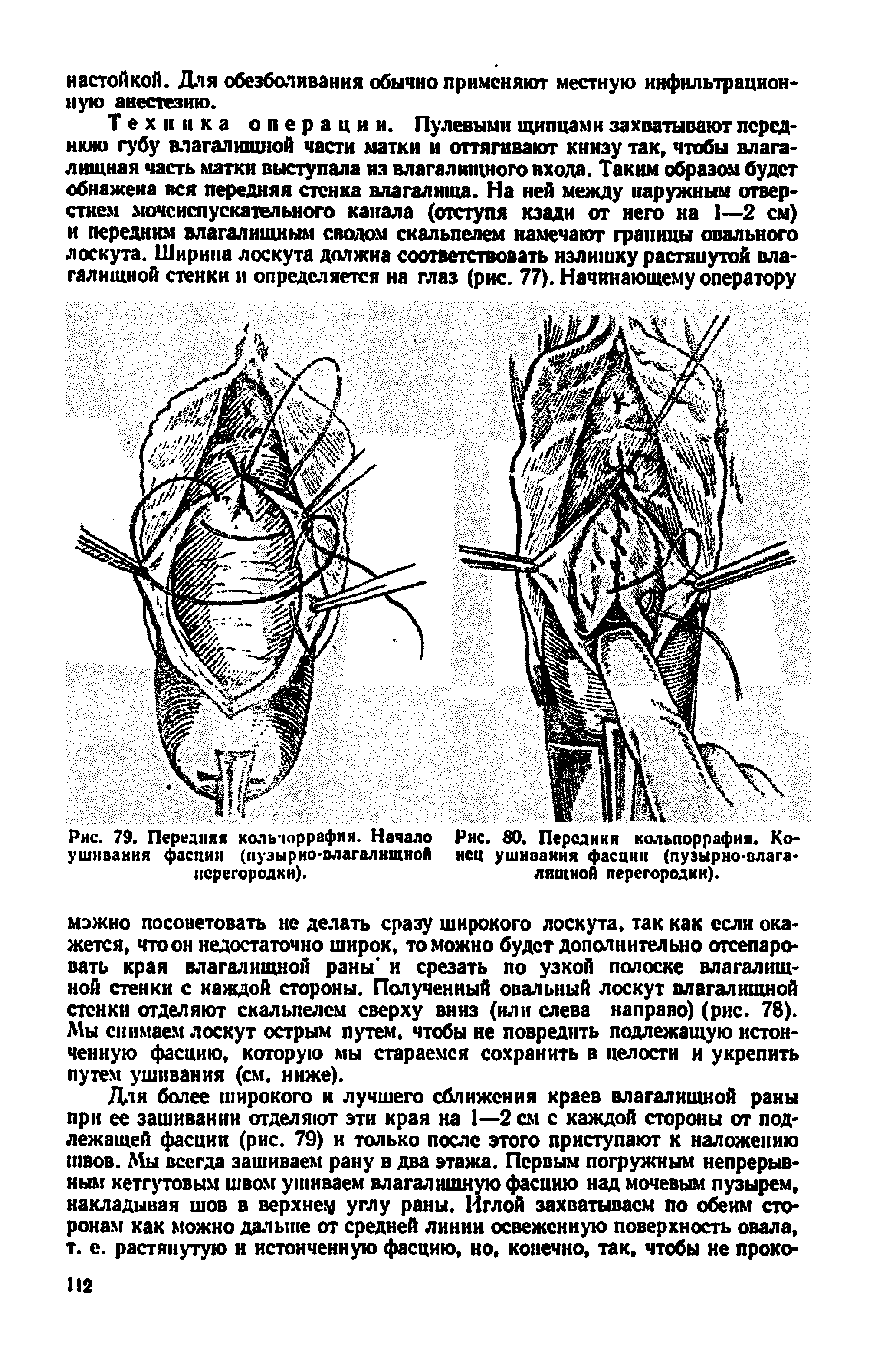 Рис. 79. Передняя коль юррафия. Начало Рис. 80. Передняя кольпоррафня. Ко-ушнвання фасции (пузырно-влагалищной нсц ушивания фасции (пузырно-влага-перегородки). лищной перегородки).