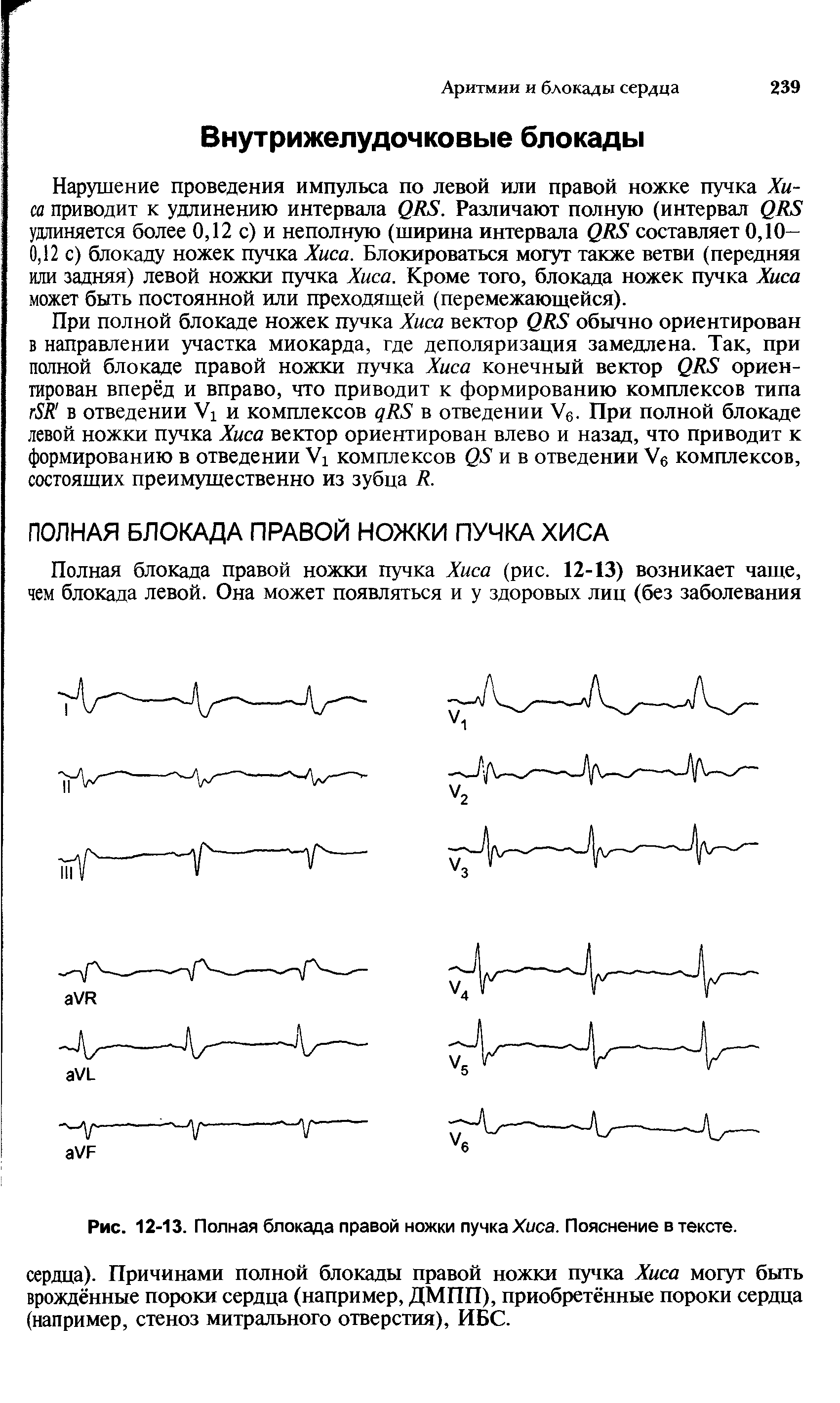 Рис. 12-13. Полная блокада правой ножки пучка Хиса. Пояснение в тексте.