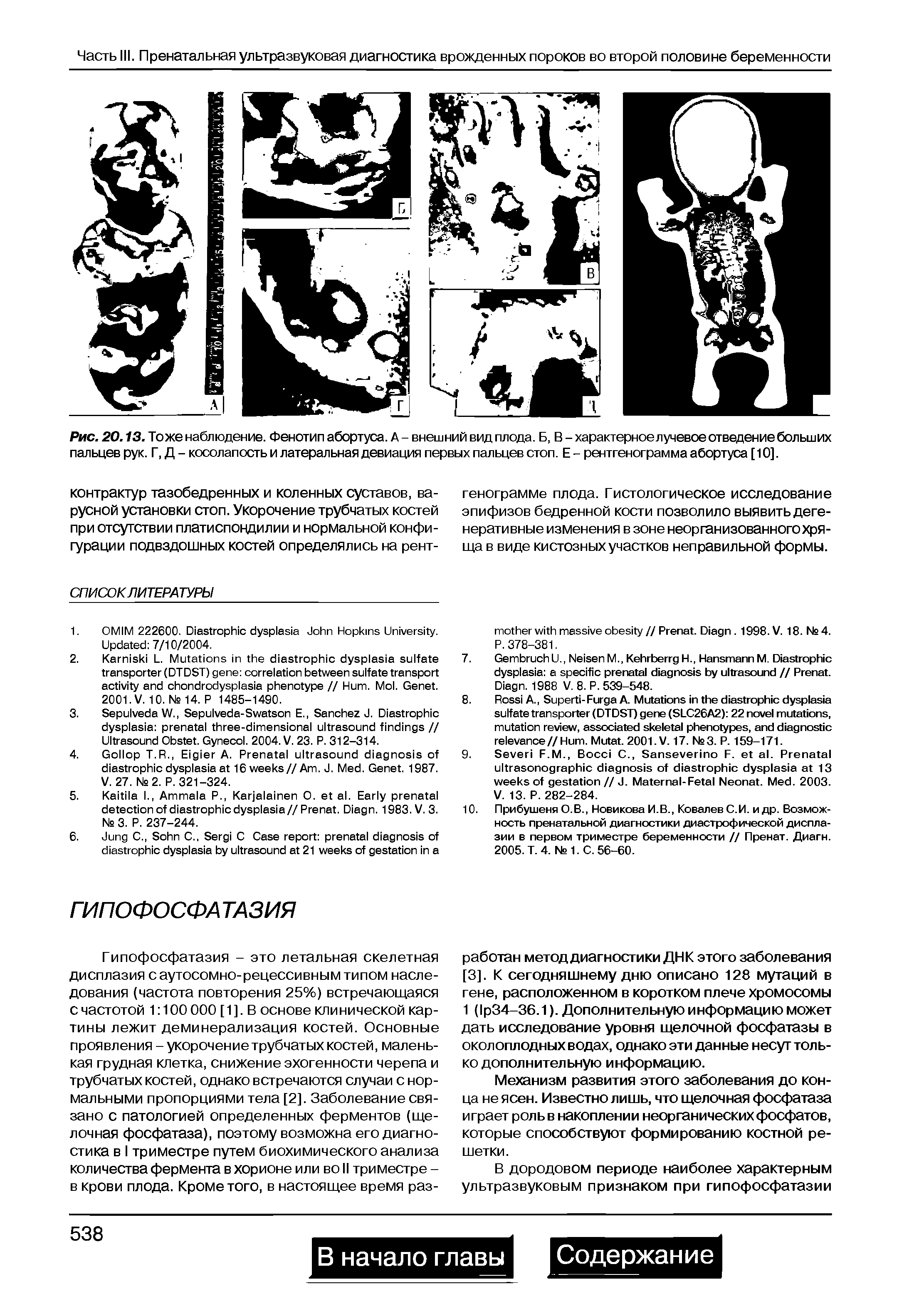 Рис. 20.13. Тоже наблюдение. Фенотип абортуса. А - внешний вид плода. Б, В - характерное лучевое отведение больших пальцев рук. Г, Д - косолапость и латеральная девиация первых пальцев стоп. Е - рентгенограмма абортуса [10].