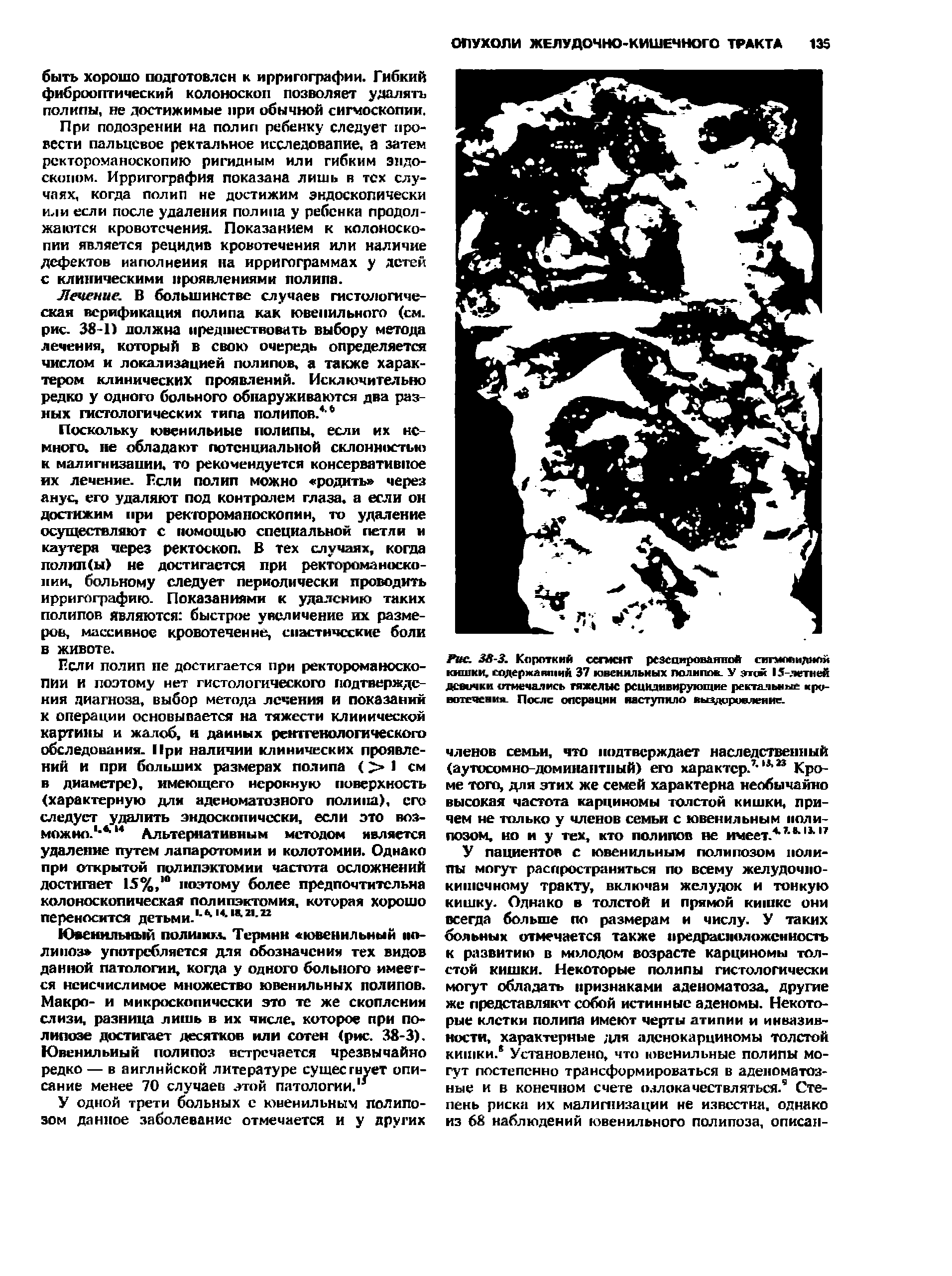 Рис. 38-3. Короткий сегмент резецированной сигмопидилй кишки, содержавший 37 ювенильных полипов. У эдж 15-летней девочки отмечались тяжелые рецидивирующие ректальные кровотечения. После операции наступило выздоровление.