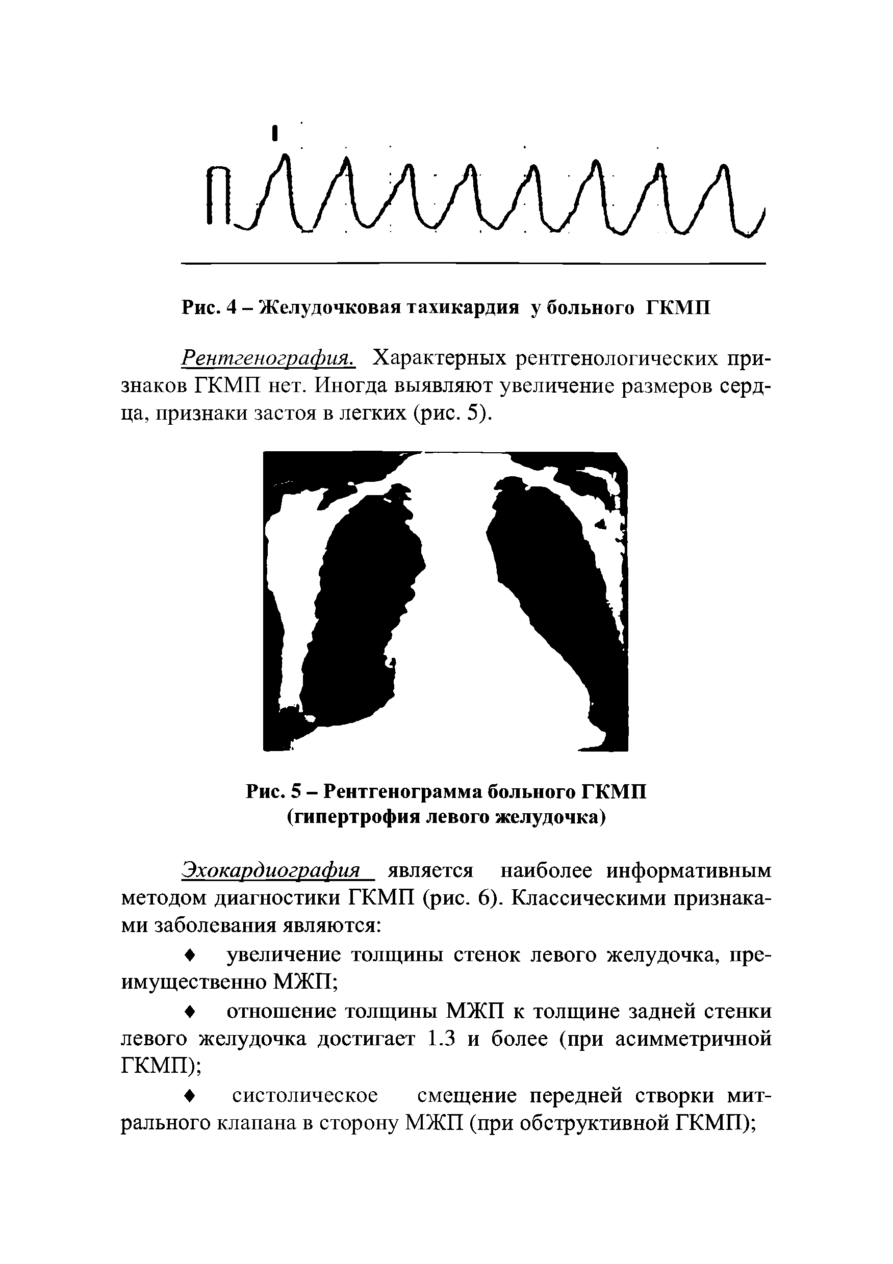 Рис. 5 - Рентгенограмма больного ГКМП (гипертрофия левого желудочка)...