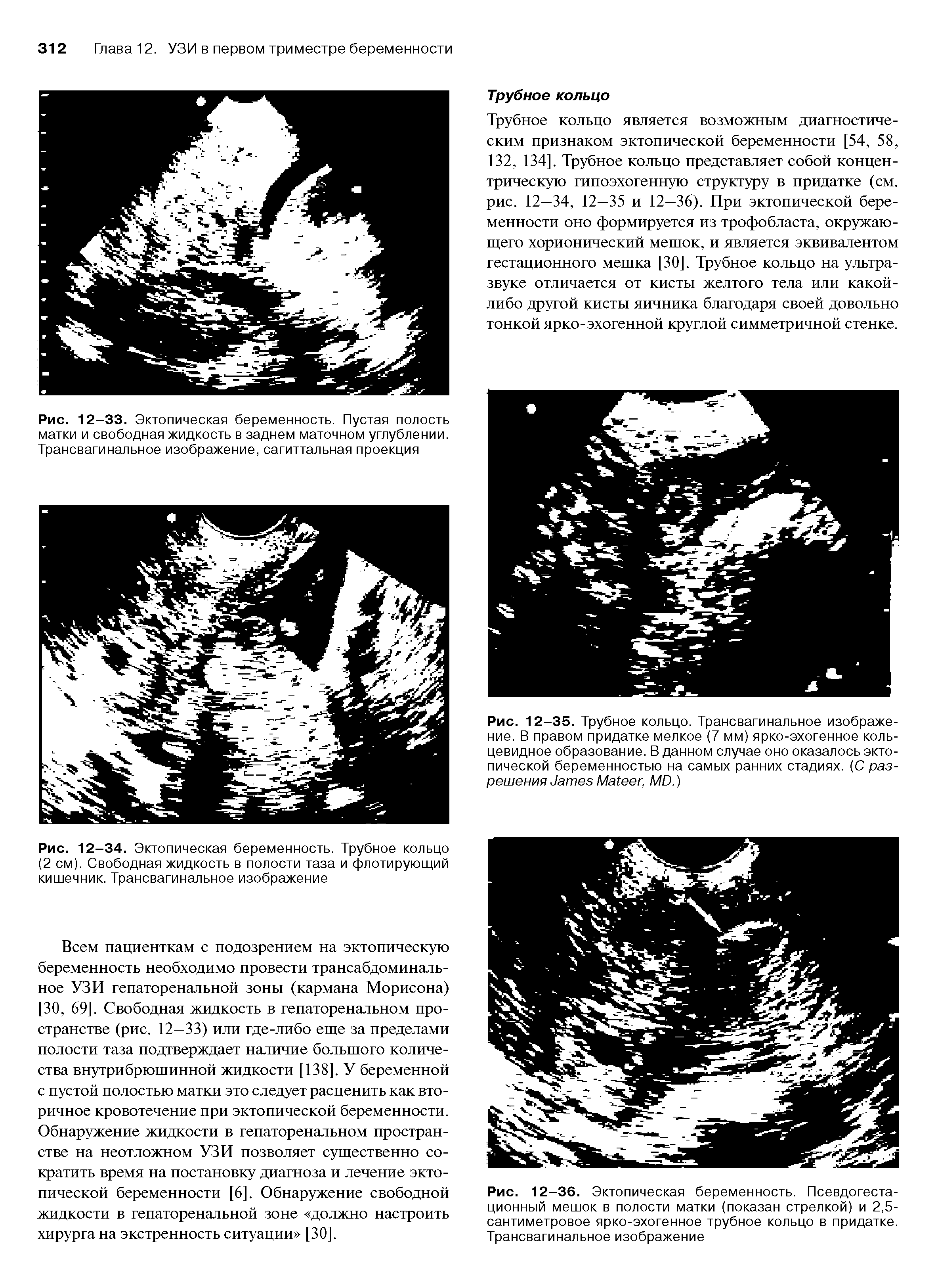 Рис. 12-36. Эктопическая беременность. Псевдогеста-ционный мешок в полости матки (показан стрелкой) и 2,5-сантиметровое ярко-эхогенное трубное кольцо в придатке. Трансвагинальное изображение...