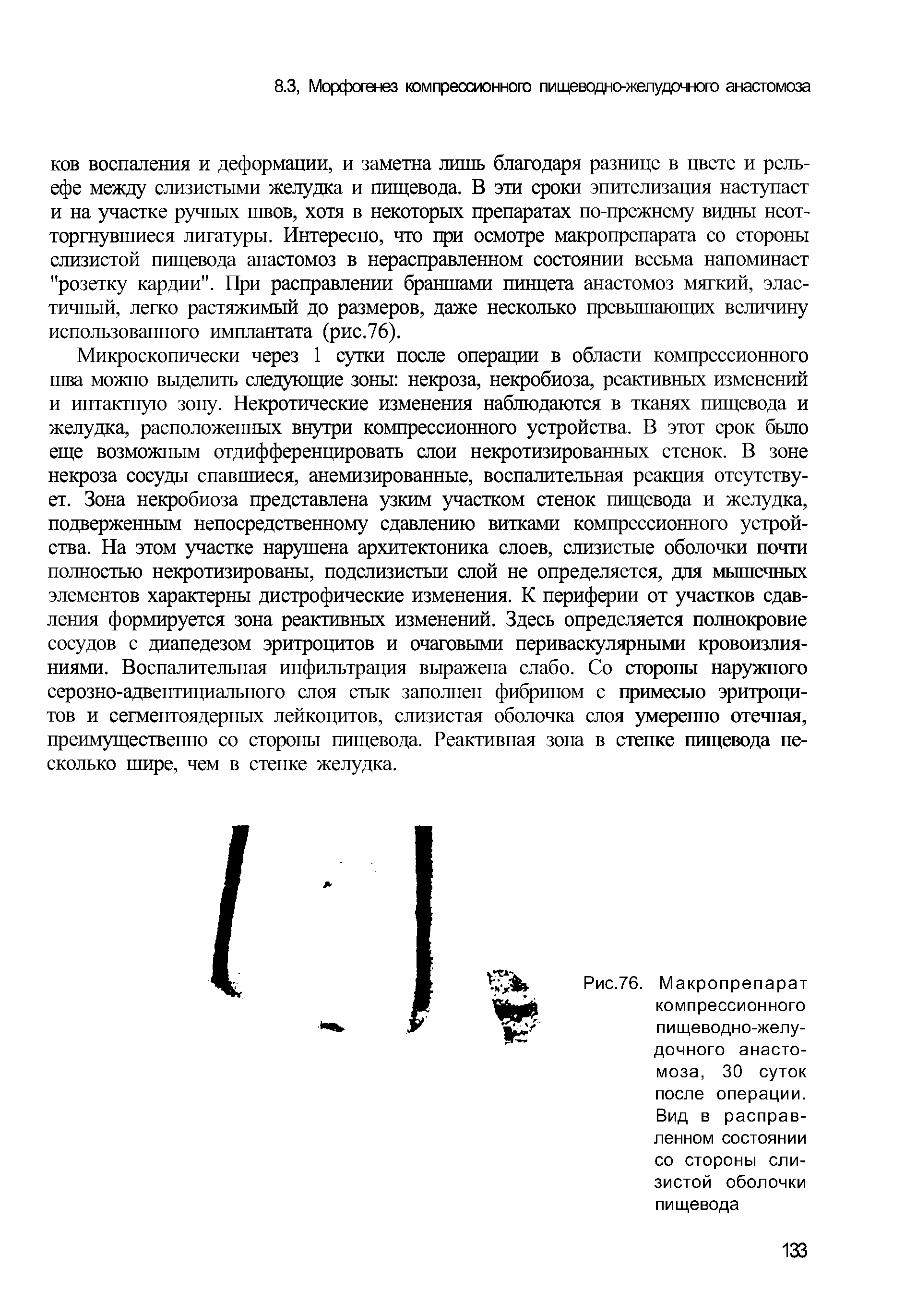 Рис.76. Макропрепарат компрессионного пищеводно-желудочного анастомоза, 30 суток после операции. Вид в расправленном состоянии со стороны слизистой оболочки пищевода...