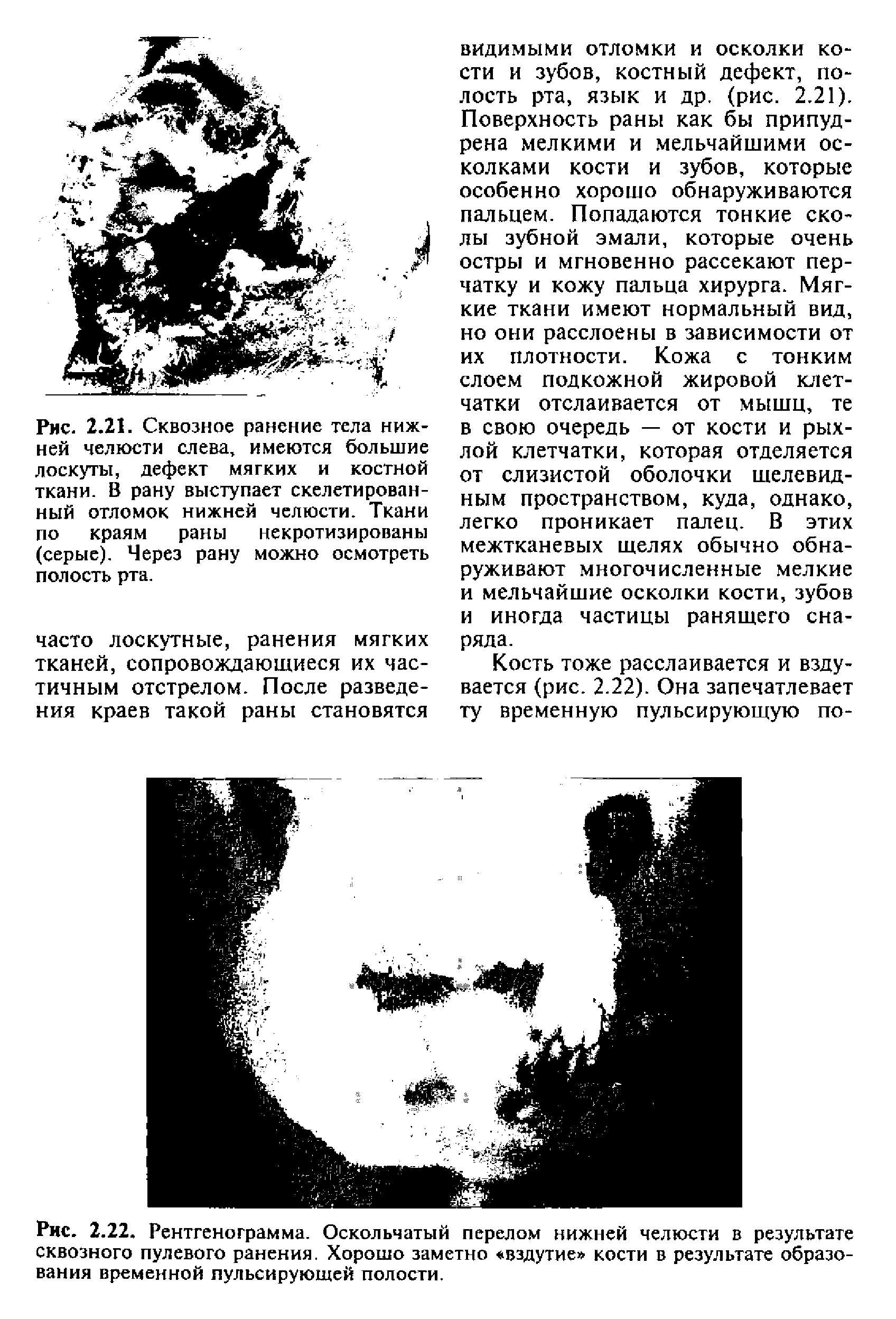 Рис. 2.22. Рентгенограмма. Оскольчатый перелом нижней челюсти в результате сквозного пулевого ранения. Хорошо заметно вздутие кости в результате образования временной пульсирующей полости.