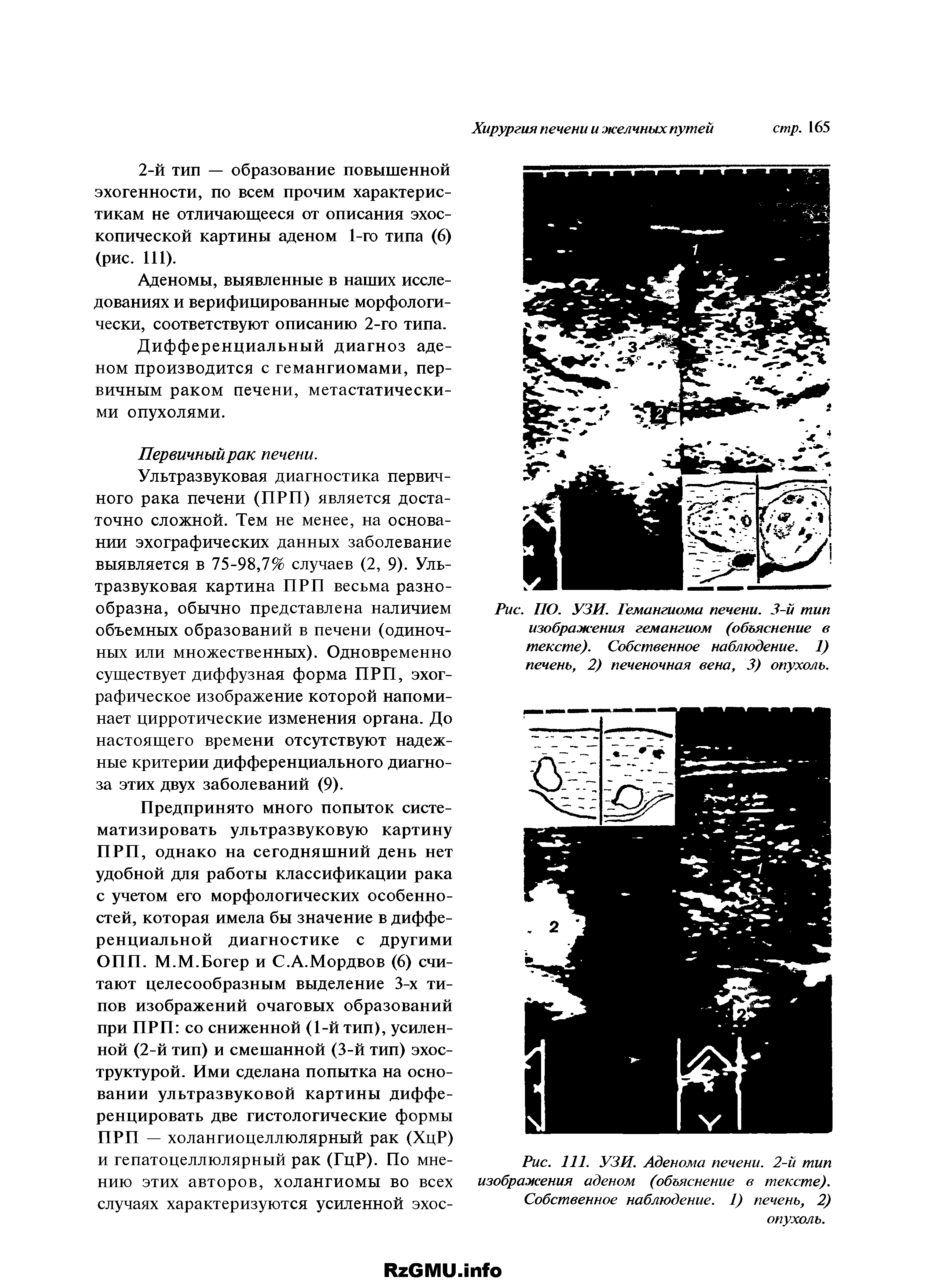 Рис. 111. УЗИ. Аденома печени. 2-й тип изображения аденом (объяснение в тексте). Собственное наблюдение. 1) печень, 2) опухоль.