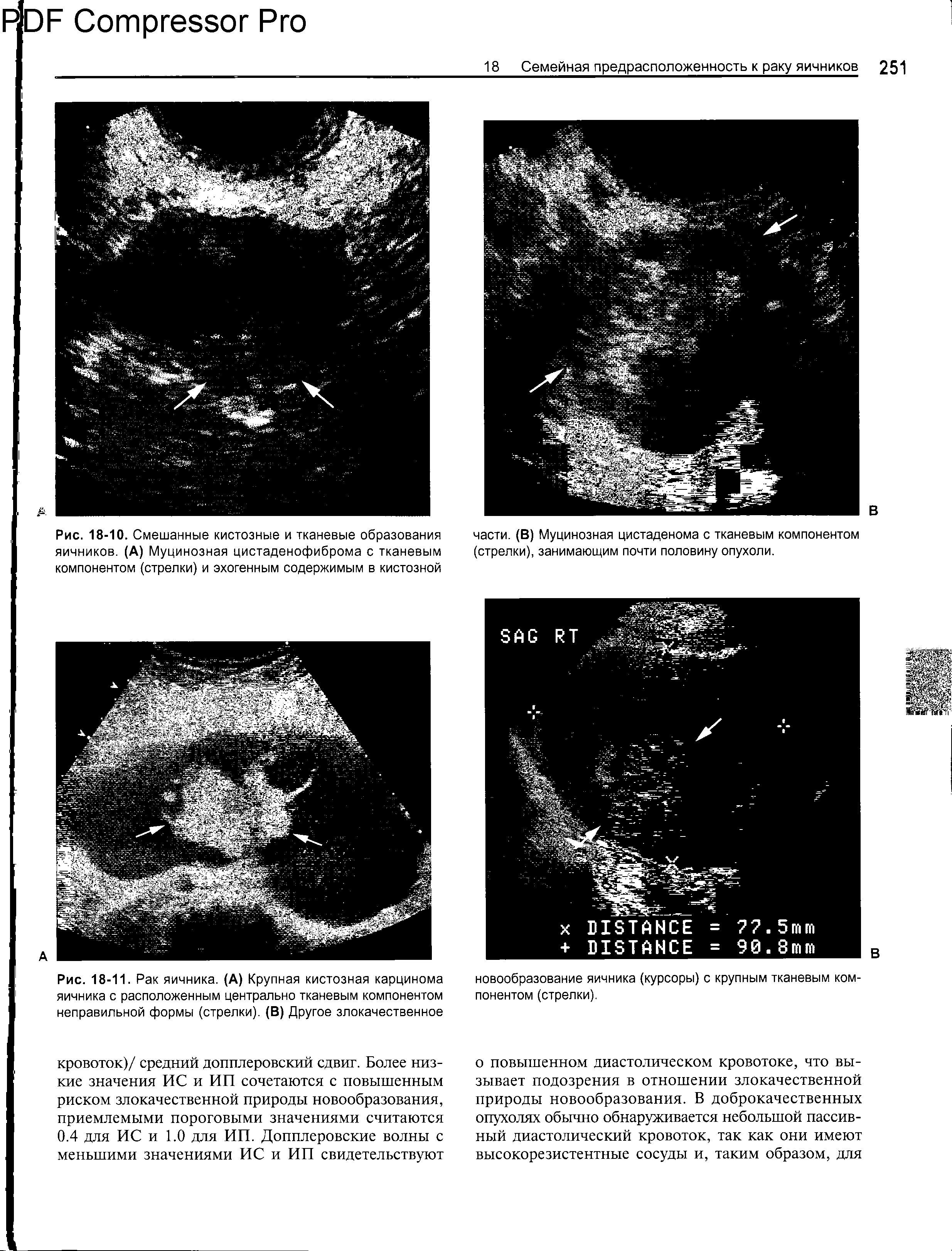 Рис. 18-10. Смешанные кистозные и тканевые образования яичников. (А) Муцинозная цистаденофиброма с тканевым компонентом (стрелки) и эхогенным содержимым в кистозной...