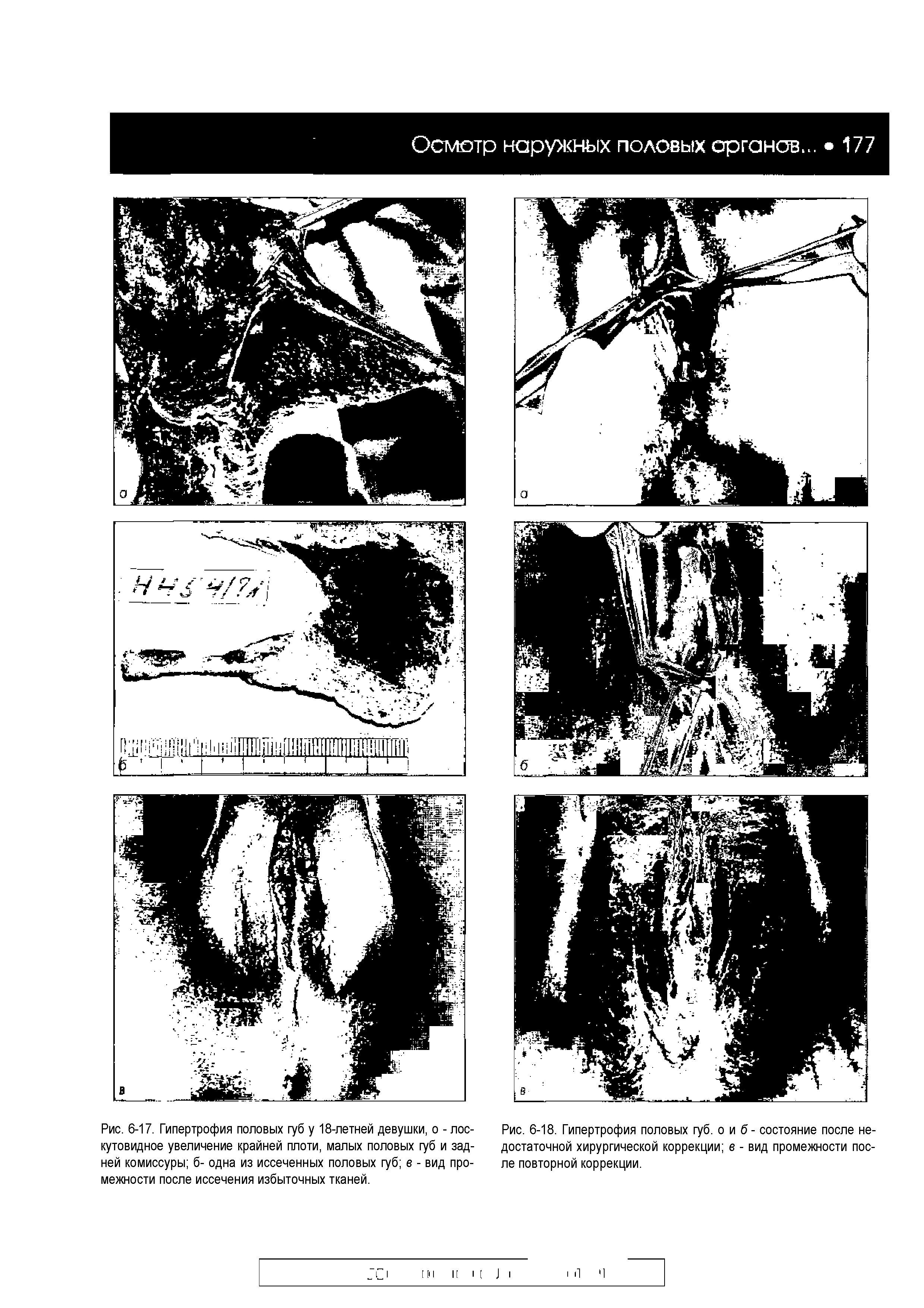 Рис. 6-18. Гипертрофия половых губ. о и б - состояние после недостаточной хирургической коррекции в - вид промежности после повторной коррекции.