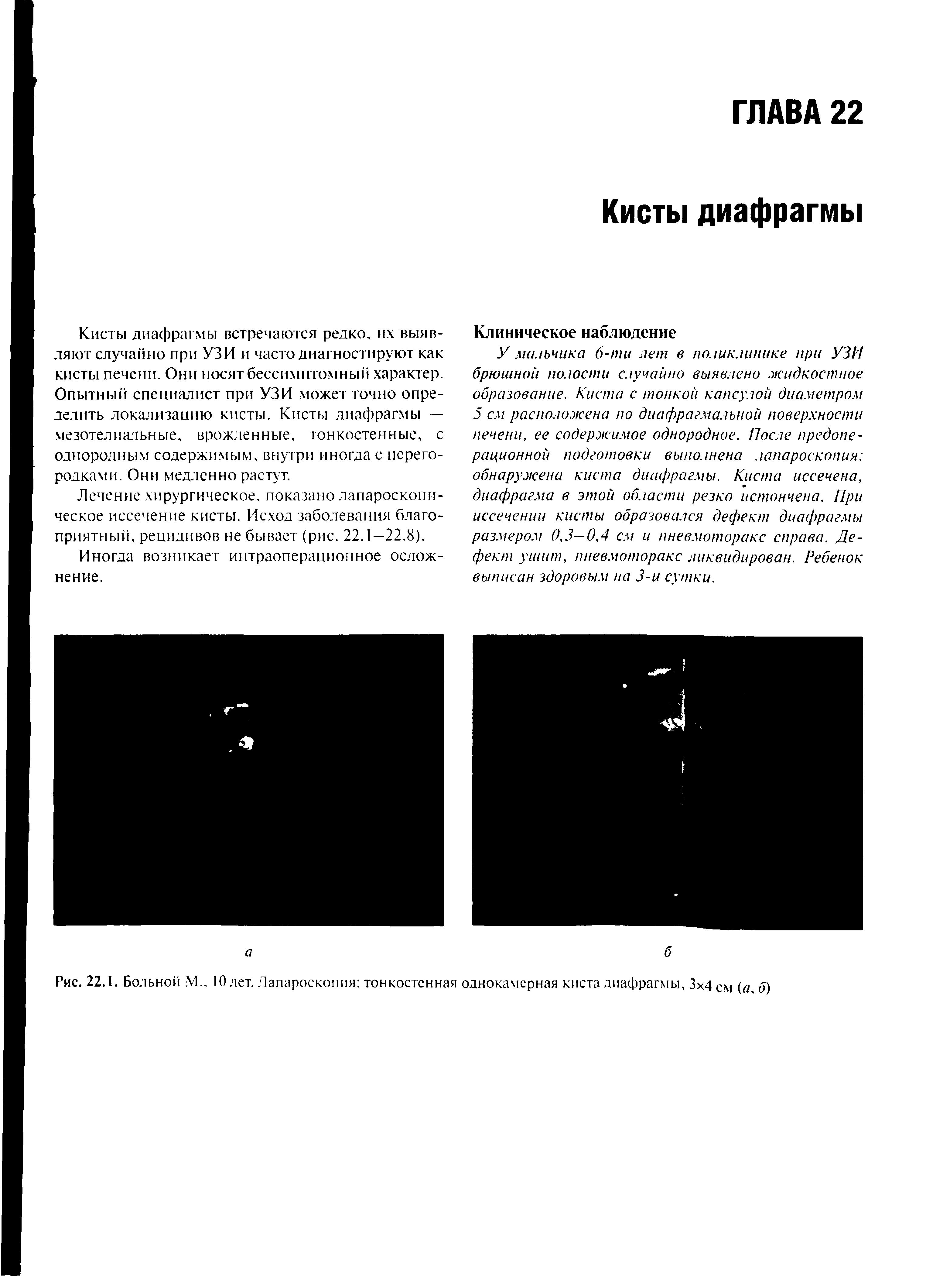 Рис. 22.1. Больной М., 10 лет. Лапароскопия тонкостенная однокамерная киста диафрагмы, 3 4 см (а б)...