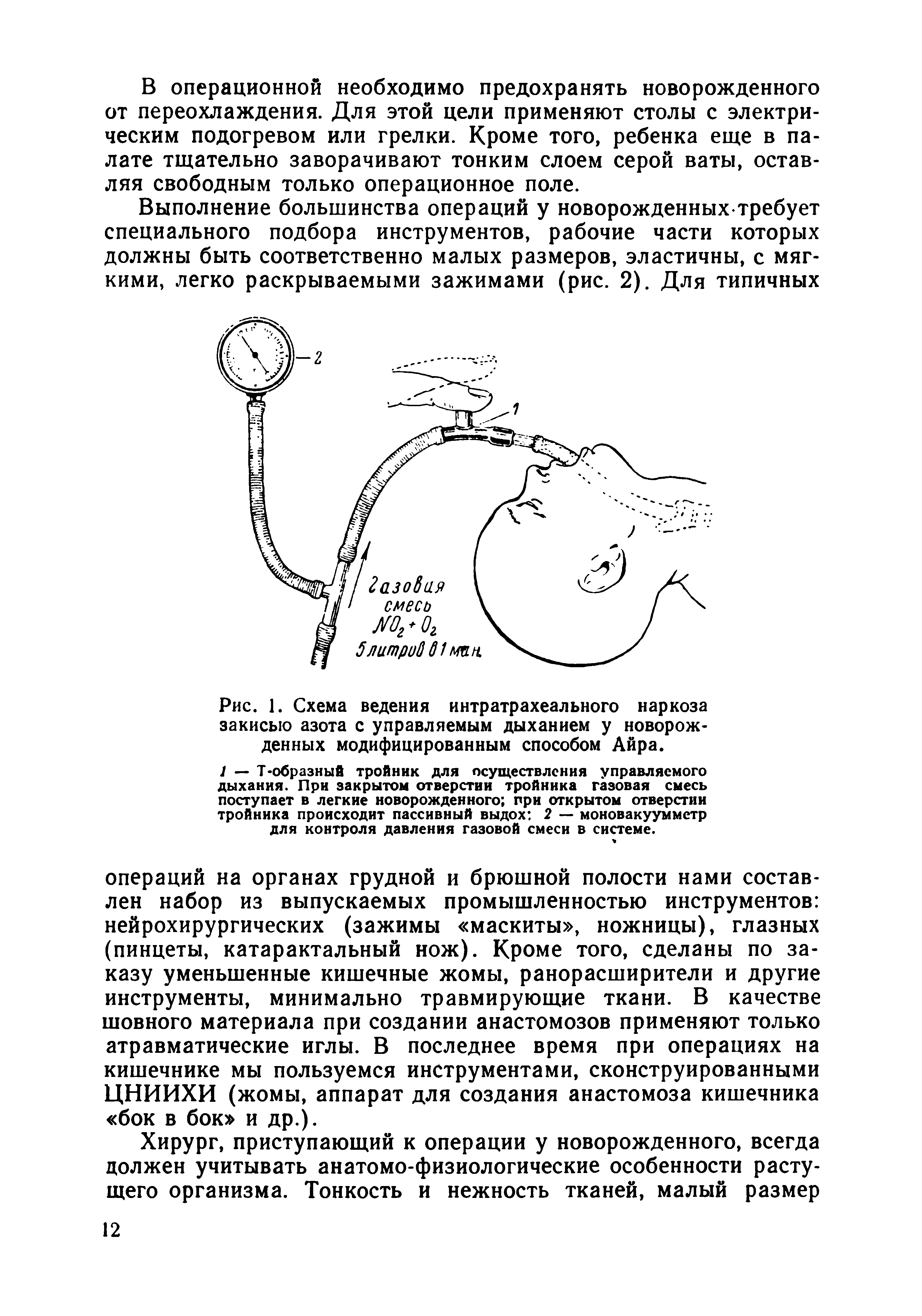 Рис. 1. Схема ведения интратрахеального наркоза закисью азота с управляемым дыханием у новорожденных модифицированным способом Айра.