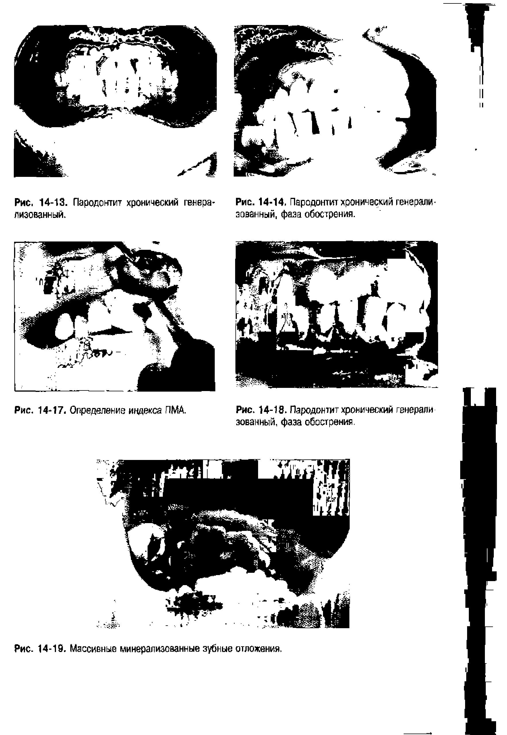 Рис. 14-18. Пародонтит хронический генерали зованный, фаза обострения.