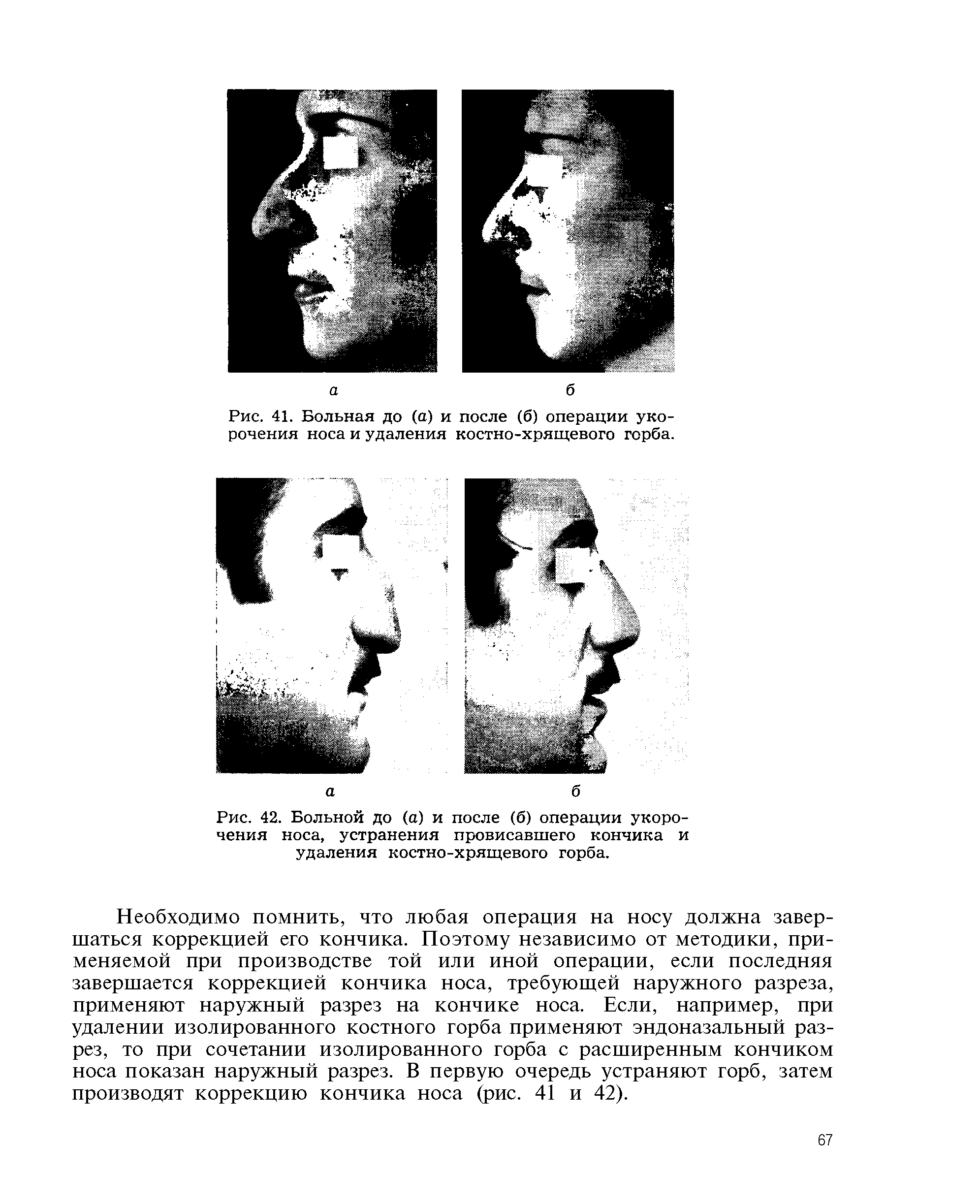 Рис. 41. Больная до (а) и после (б) операции укорочения носа и удаления костно-хрящевого горба.