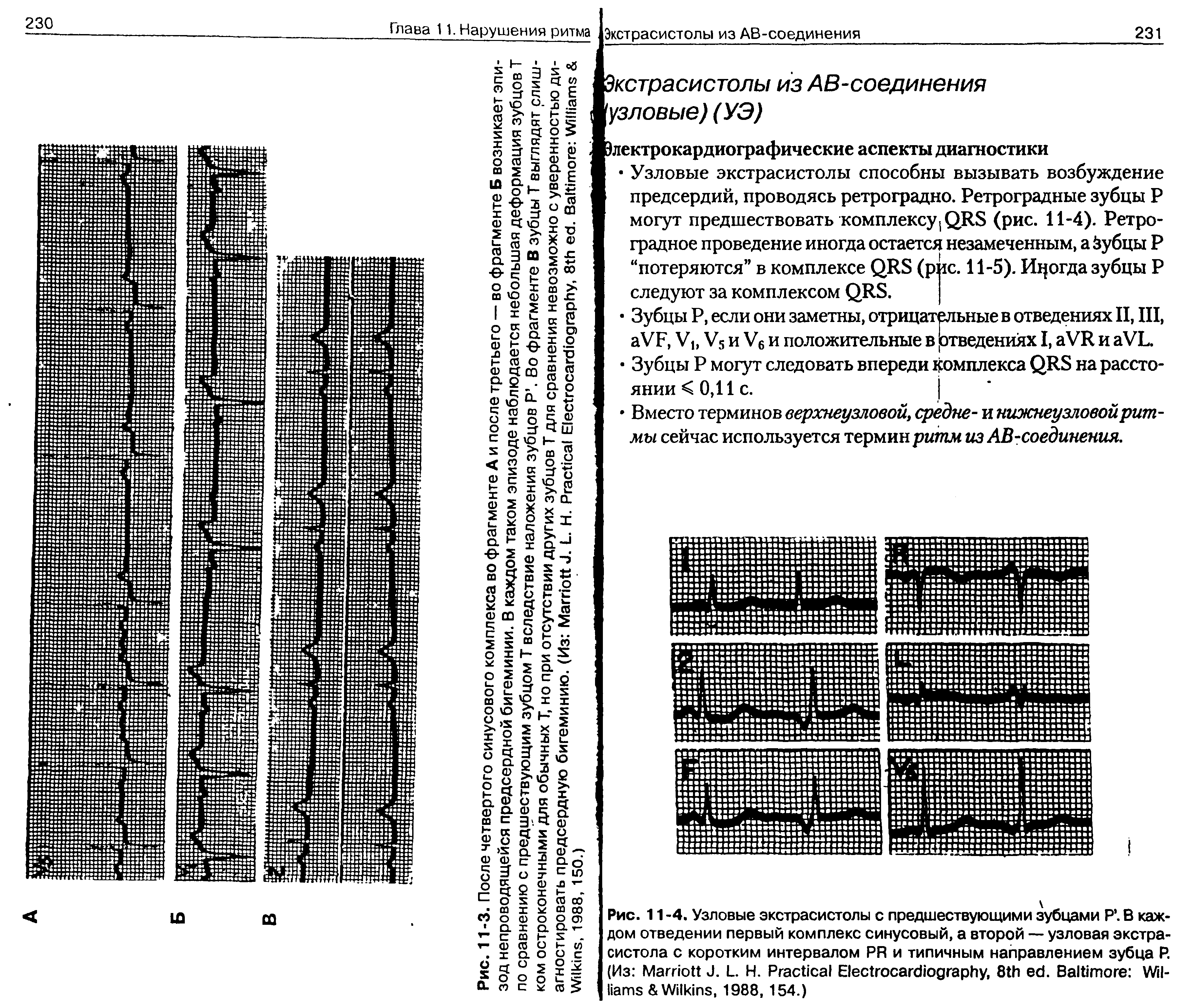 Рис. 11 -4. Узловые экстрасистолы с предшествующими зубцами Р . В каждом отведении первый комплекс синусовый, а второй — узловая экстрасистола с коротким интервалом PR и типичным направлением зубца Р. (Из M J. L. Н. P E , 8 . B W W , 1988, 154.)...