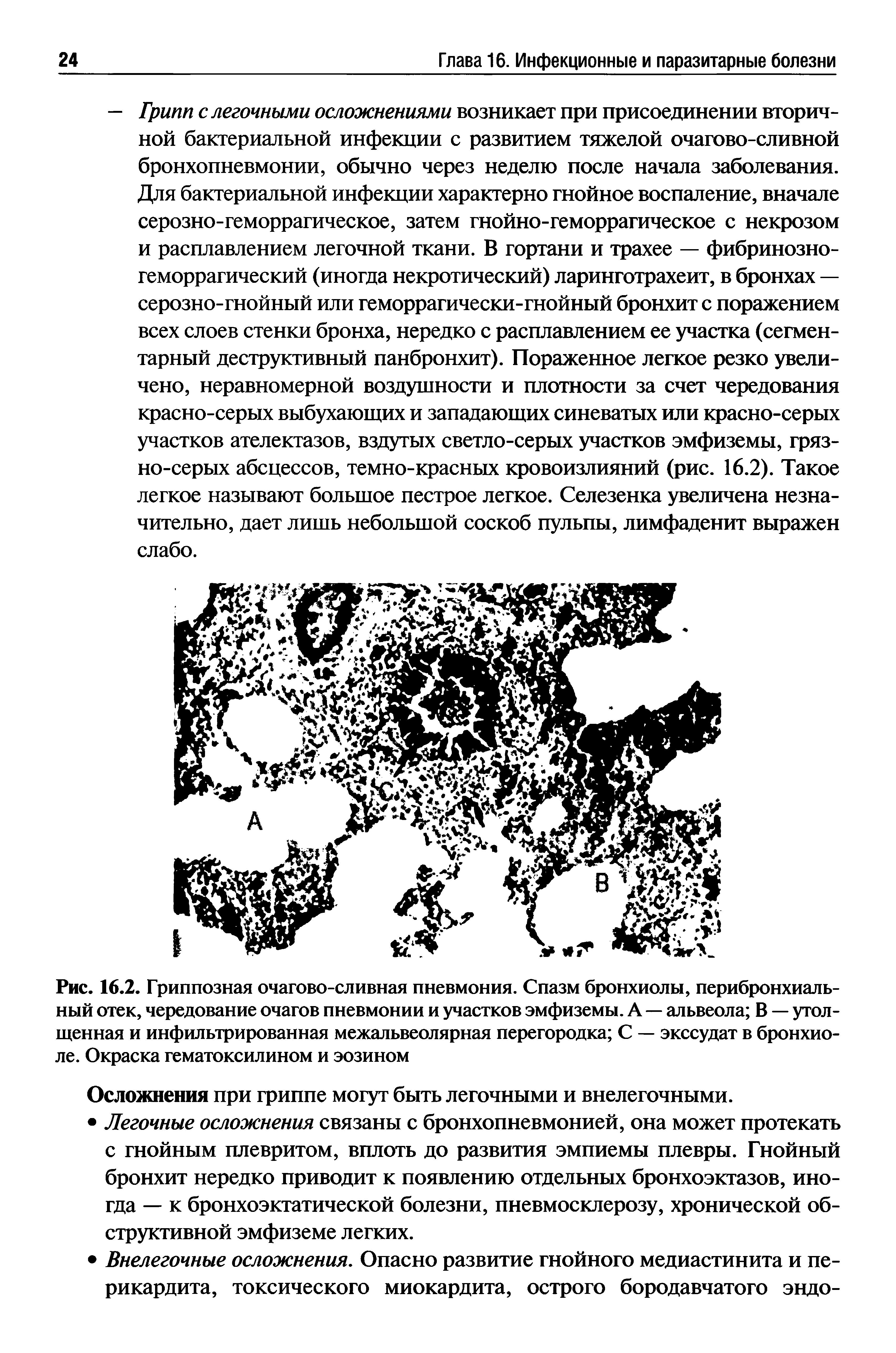 Рис. 16.2. Гриппозная очагово-сливная пневмония. Спазм бронхиолы, перибронхиаль-ный отек, чередование очагов пневмонии и участков эмфиземы. А — альвеола В — утолщенная и инфильтрированная межальвеолярная перегородка С — экссудат в бронхиоле. Окраска гематоксилином и эозином...