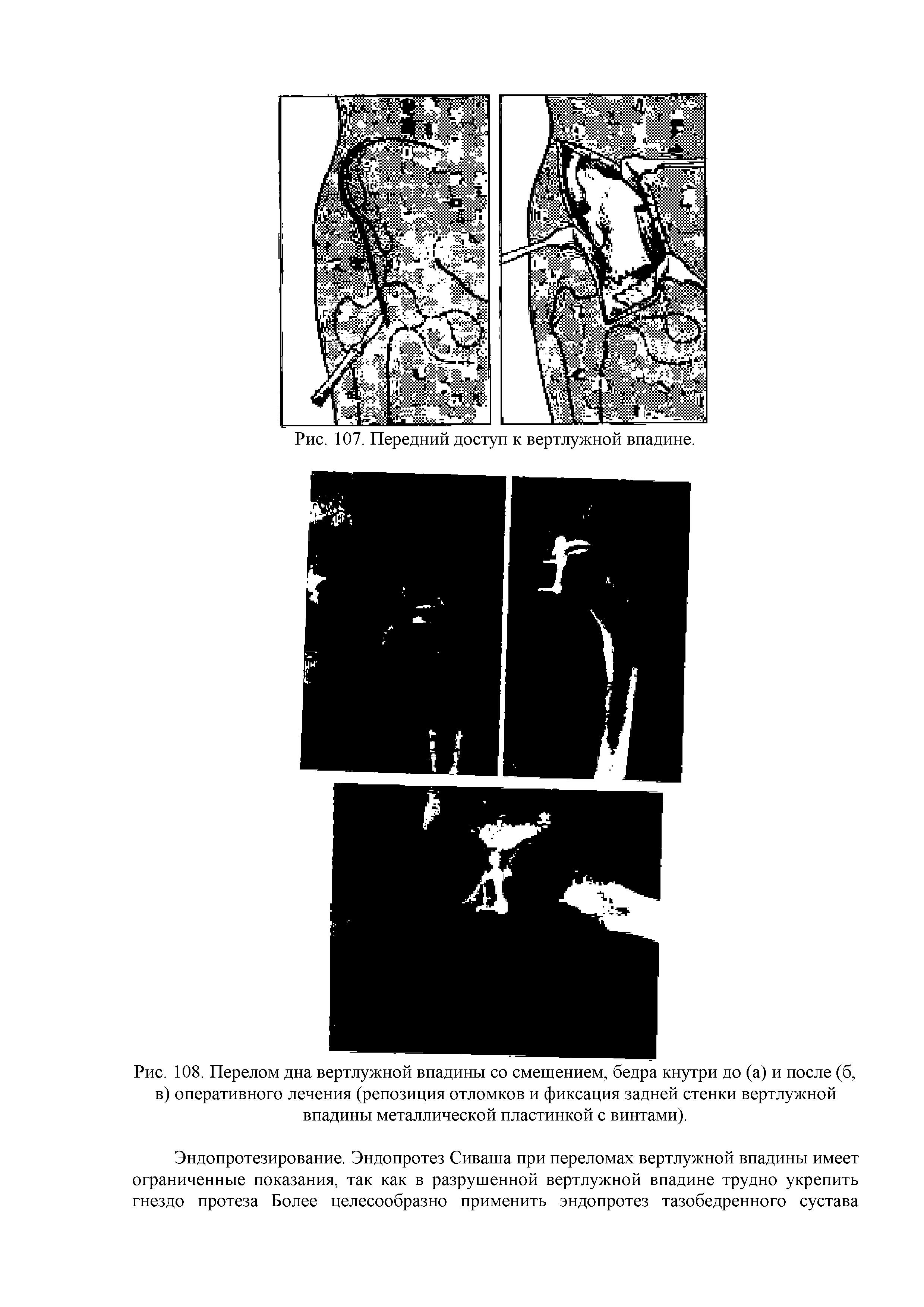 Рис. 108. Перелом дна вертлужной впадины со смещением, бедра кнутри до (а) и после (б, в) оперативного лечения (репозиция отломков и фиксация задней стенки вертлужной впадины металлической пластинкой с винтами).