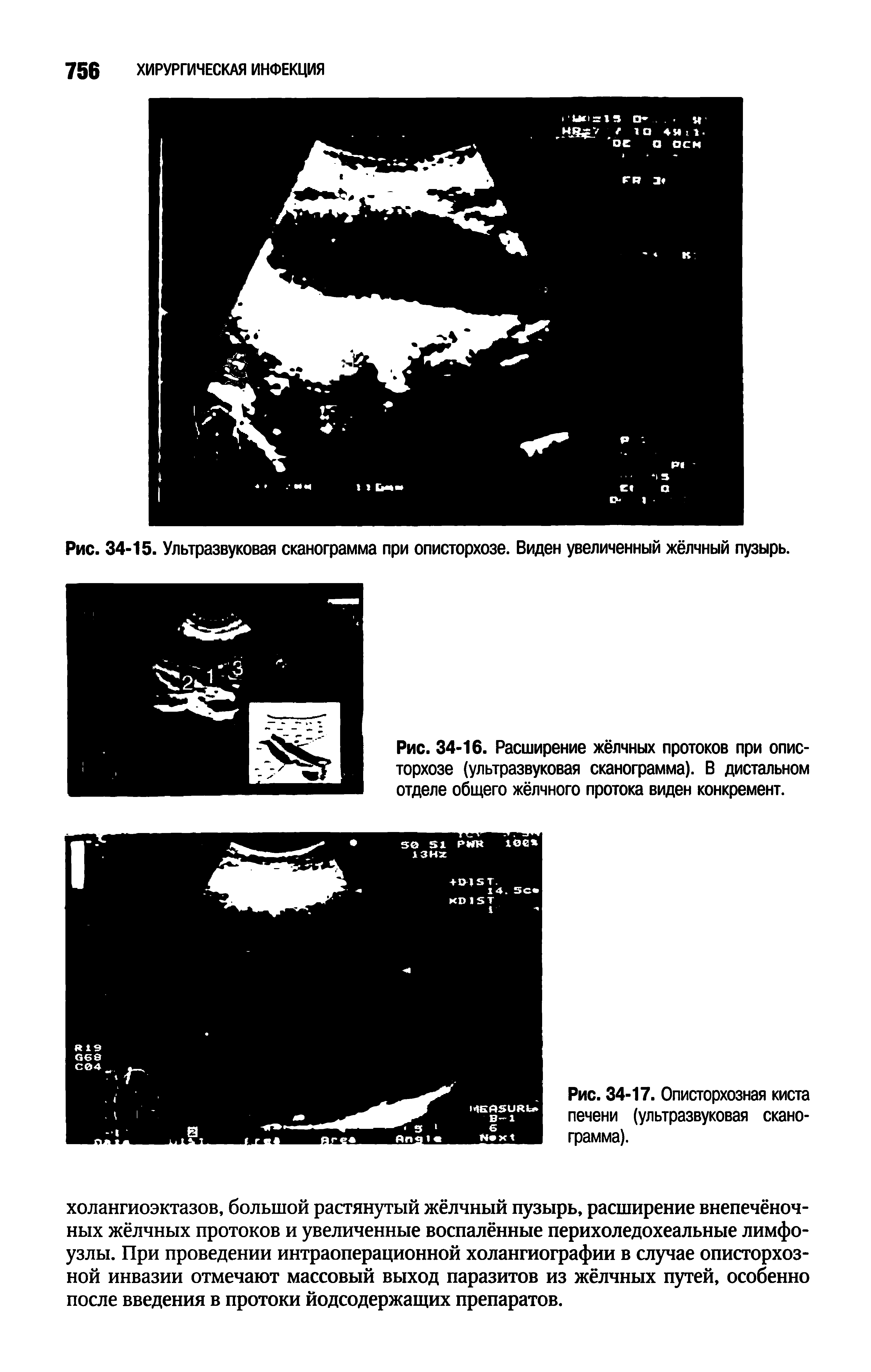 Рис. 34-16. Расширение жёлчных протоков при описторхозе (ультразвуковая сканограмма). В дистальном отделе общего жёлчного протока виден конкремент.