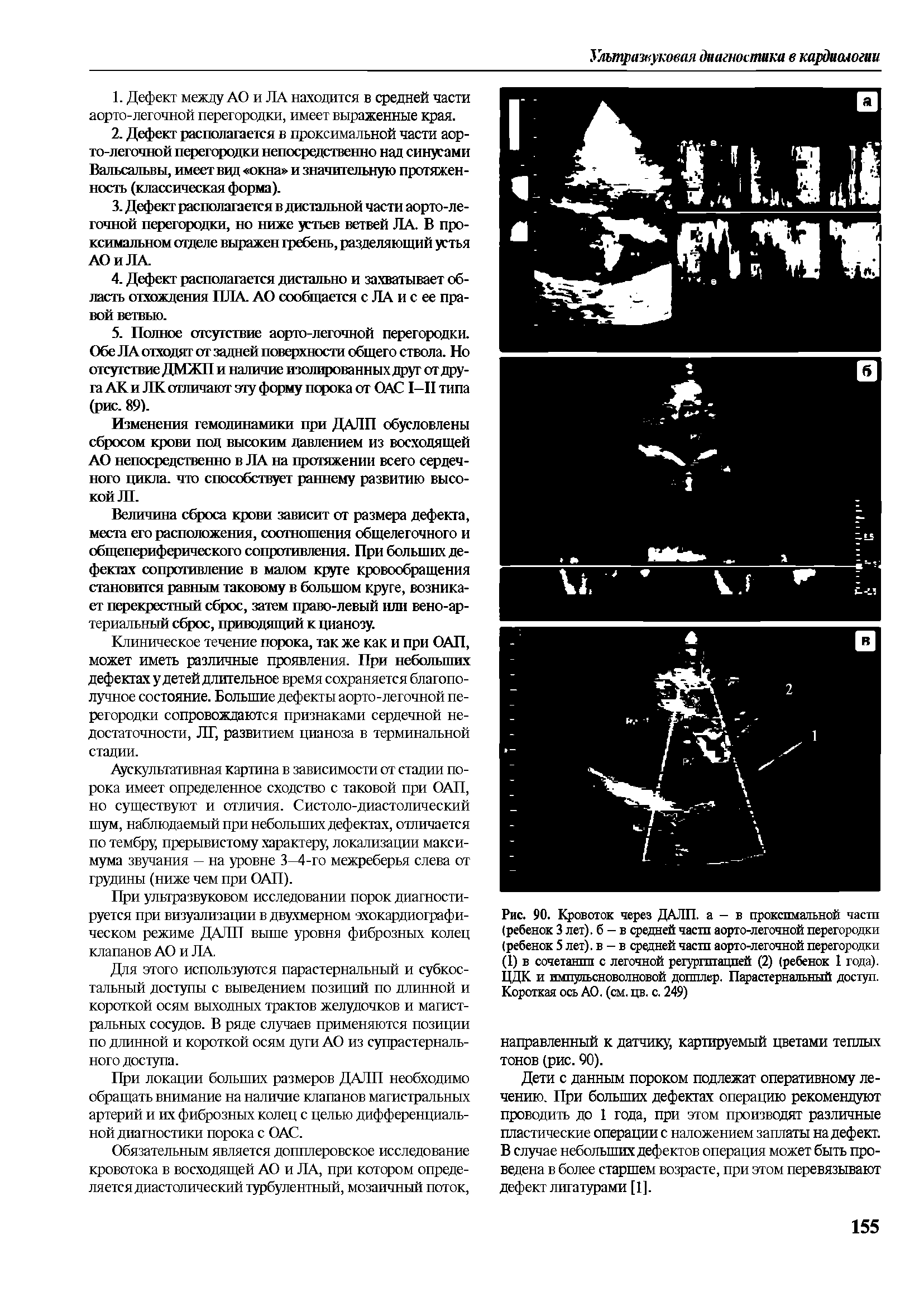 Рис. 90. Кровоток через ДАЛП. а - в проксимальной части (ребенок 3 лет), б - в средней част аорто-легочной перегородки (ребенок 5 лет), в-в средней части аорто-легочной перегородки (1) в сочетании с легочной регургитацией (2) (ребенок 1 года). ЦДК и импульсноволновой допплер. Парастернальный доступ. Короткая ось АО. (см. цв. с. 249)...